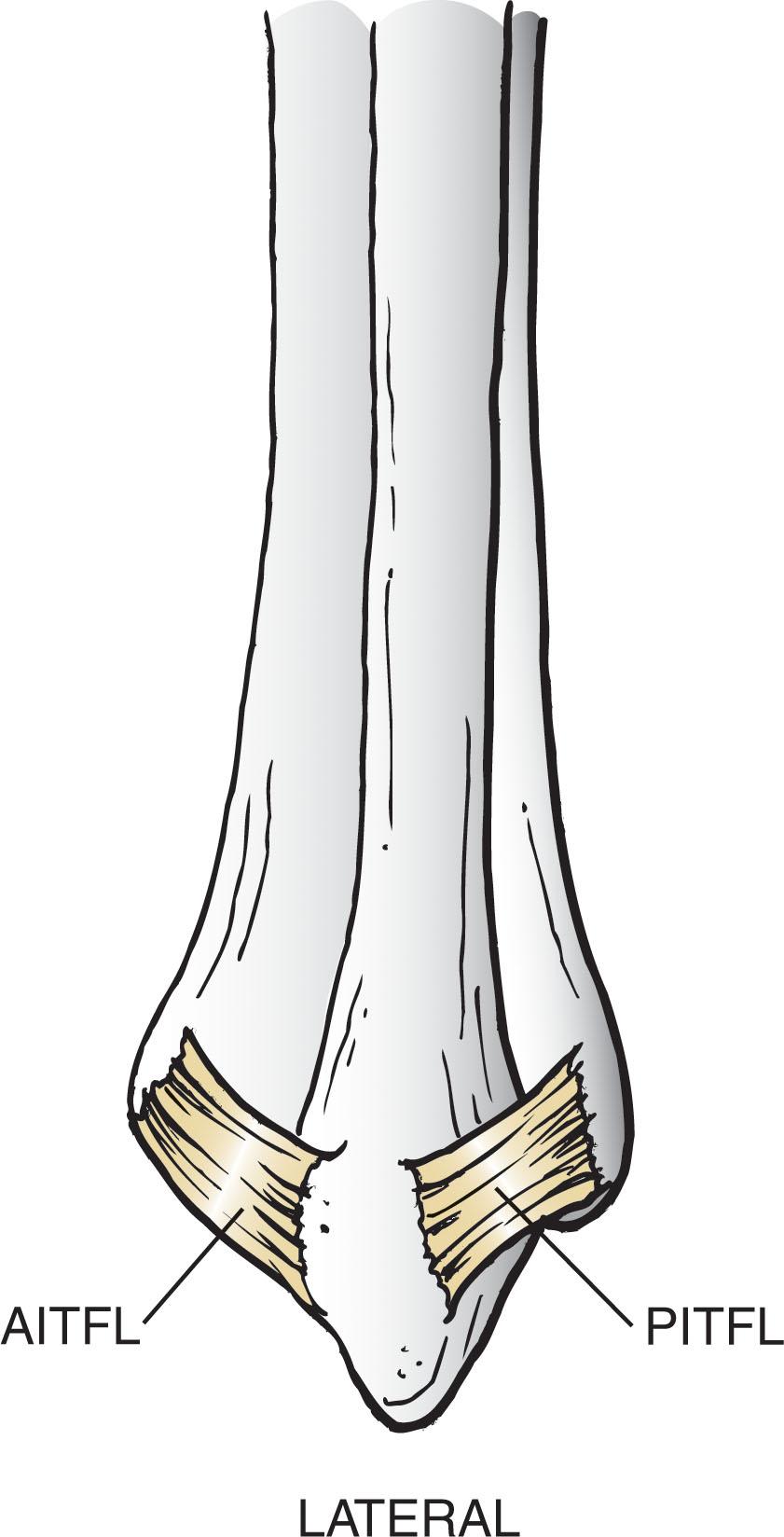 Fig. 44-6, Lateral syndesmotic ligaments. The anterior and posterior inferior tibiofibular ligaments ( AITFL and PITFL ) and, between them, the fibulocalcaneal ligament, which crosses the talus.