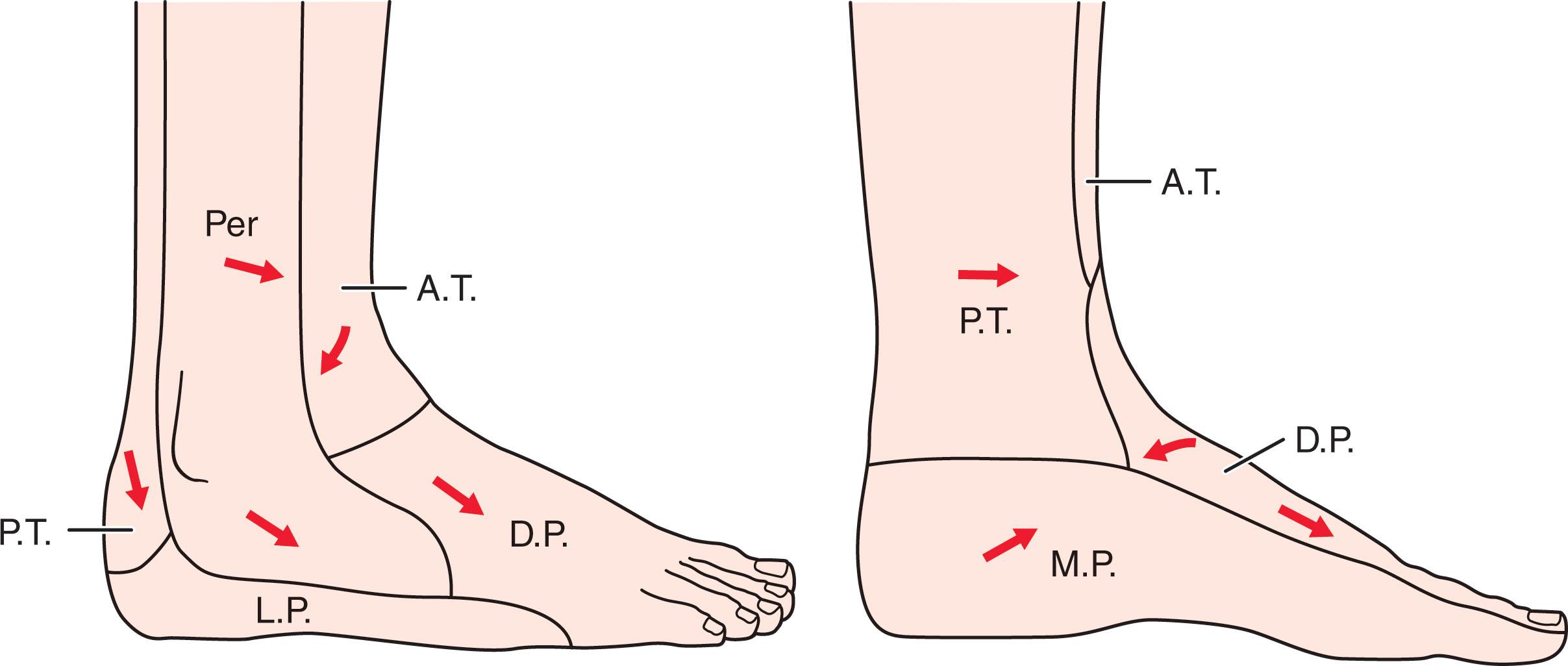 Fig. 44-7, Angiosomes of the foot. A.T. , anterior tibial artery; D.P. , dorsalis pedis artery; L.P. , lateral plantar artery; M.P. , medial plantar artery; P.T. , posterior tibial artery; Per , peroneal artery