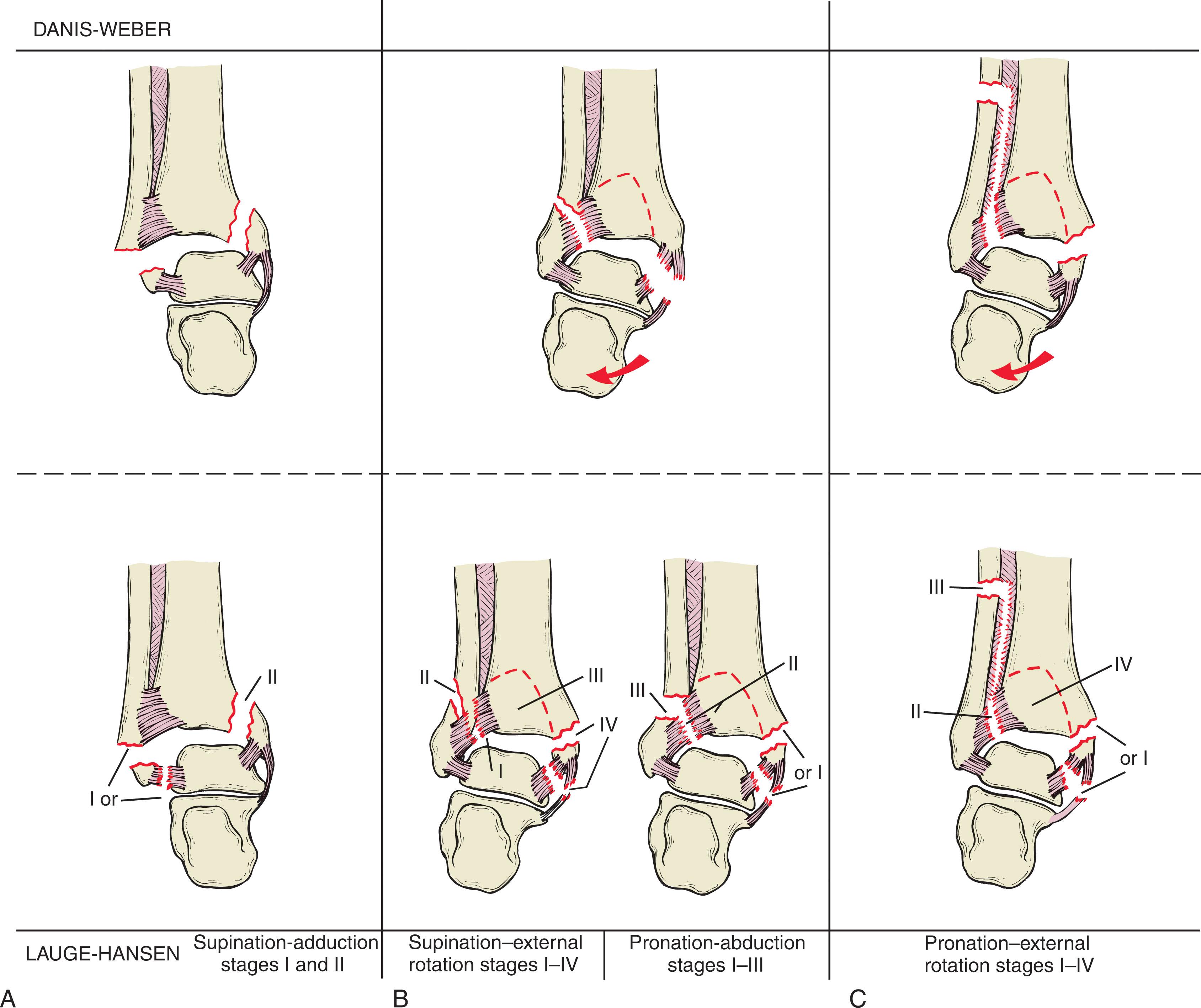 Fig. 44-8, Correlation of the Danis-Weber and Lauge-Hansen classification systems.
