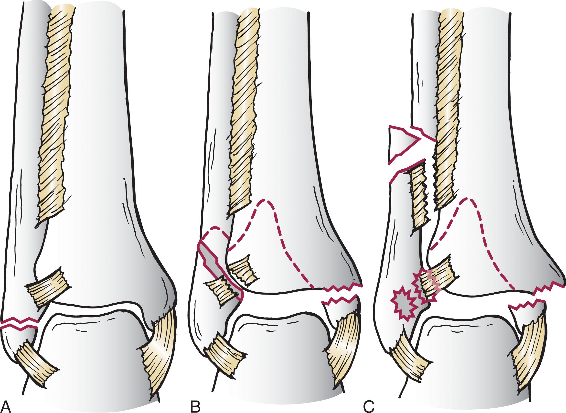 Fig. 44-9, AO Müller classification for ankle fractures. A , Type A injuries. B , Type B injuries. C , Type C injuries. AO , Association for osteosynthesis.