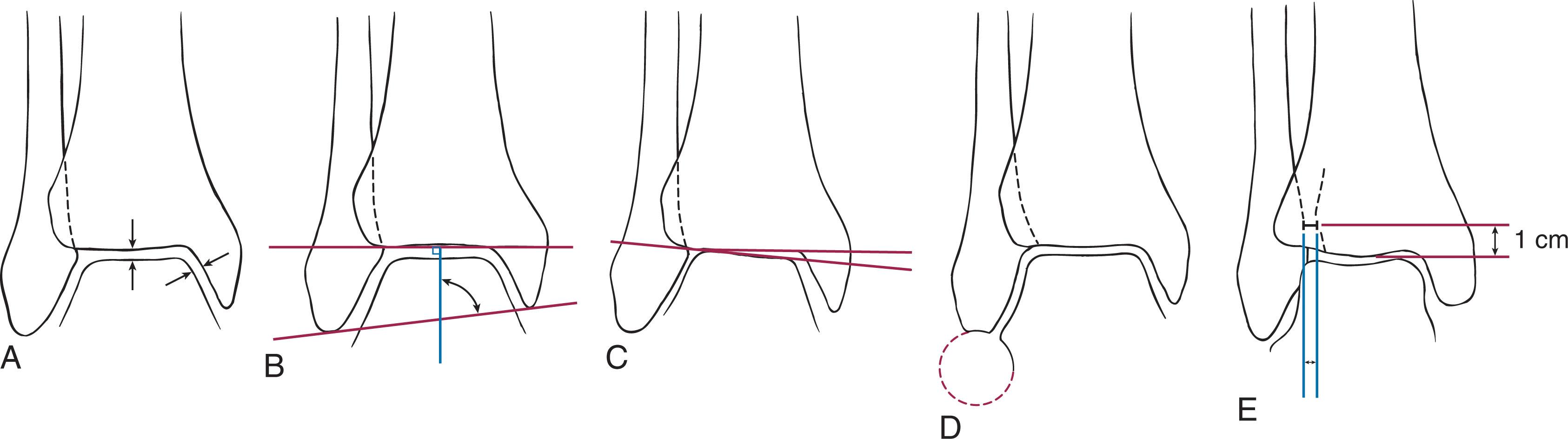 Fig. 44-10, Plain radiographs should be evaluated for documented reduction criteria. A , The medial clear space on mortise views should be less than 4 mm and the superior joint space within 2 mm medially of its width laterally. The joint space should be relatively symmetric. B , The talocrural angle is 83 degrees ± 4 degrees and normally within 2 degrees of the opposite ankle. C , The talar tilt angle (<2 mm). D , Mortise view demonstrating the Shenton line and the continuous curve between the lateral talus and the recessed tip of the distal fibula. E , Syndesmotic width on the anteroposterior view. The space between the medial wall of the fibula and the incisural surface of the tibia should be less than 5 mm. The anterior tubercle of the tibia should overlap the fibula by at least 10 mm.