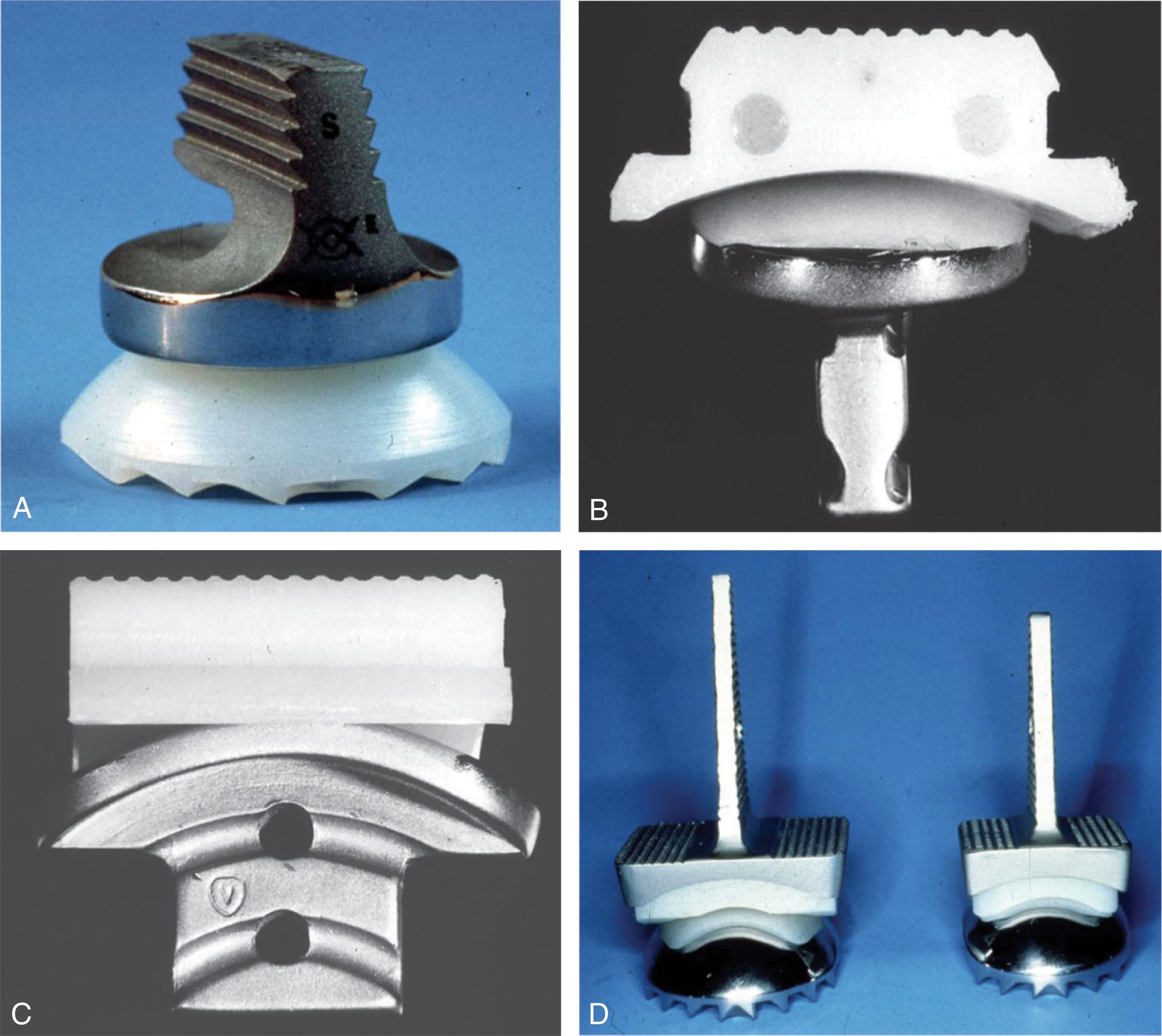 Fig. 23-3, Examples of first-generation total ankle replacements (TARs). These tended to be two-component designs with one component being all-polyethylene. A , Richard Smith two-component unconstrained TAR with an all-polyethylene talus. B and C , Newton unconstrained TAR with an all-polyethylene tibia. D , Irvine unconstrained TAR with metal backed components.