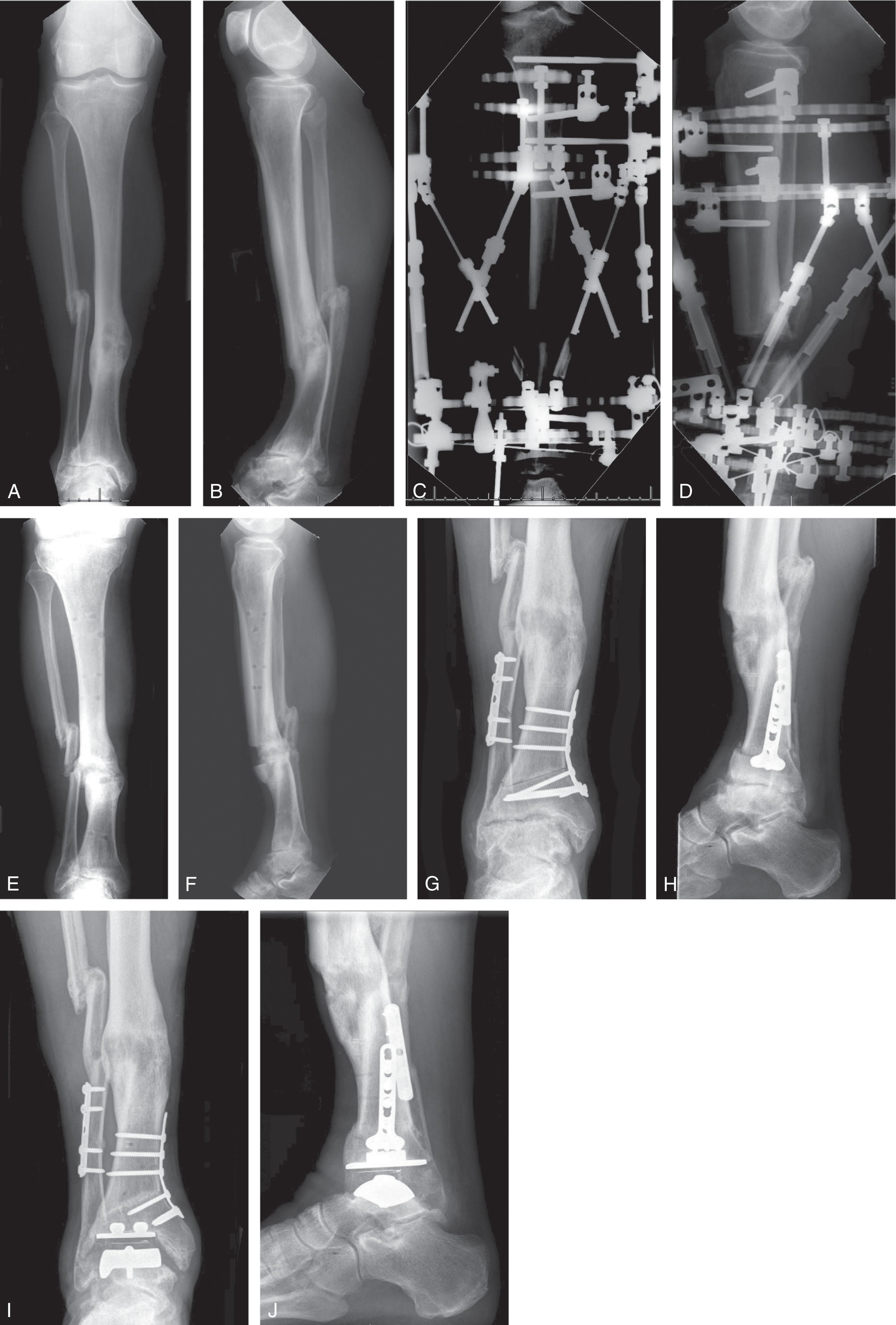 Fig. 23-13, Managing tibial deformity before total ankle replacement. A and B , Anteroposterior and lateral radiographs of the tibia showing posttraumatic ankle arthritis and tibial shaft malunion including apex posterior angular deformity. C and D , A ringed external fixator has been applied and gradual correction performed through distraction osteogenesis. E and F , After fixator removal, the regenerate drifted into valgus as it healed. Mild posterior translation was accepted. G and H , A medial closing wedge supramalleolar osteotomy was performed to improve the ankle coronal plane alignment. I and J , With the improved tibial alignment, a total ankle was implanted using standard techniques and without requiring additional bony or soft tissue balancing procedures.