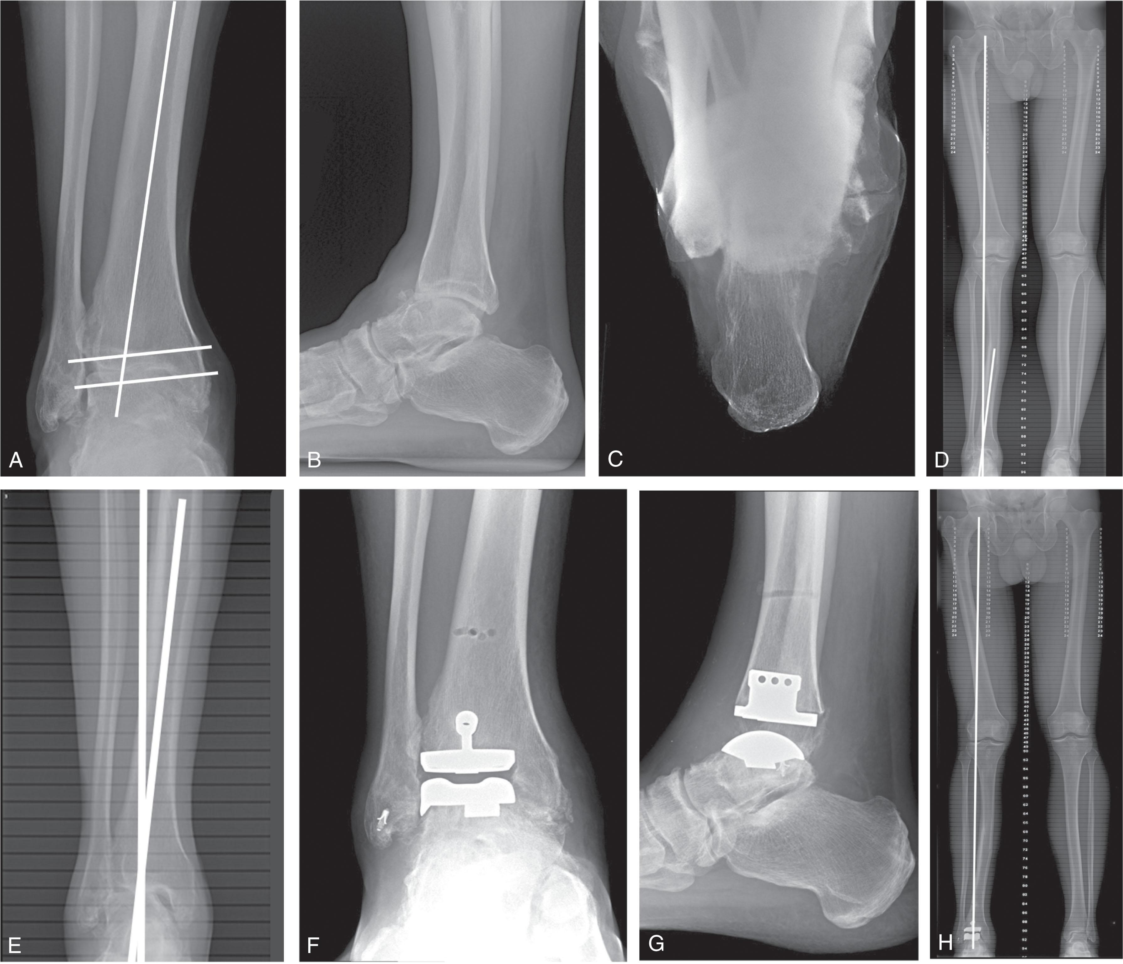 Fig. 23-14, Accommodating a tibial deformity by adjusting total ankle bone cuts. A and B , Anteroposterior and lateral radiographs showing ankle arthritis with a varus congruent deformity. Notice both the distal tibia and talus are angulated relative to the distal tibial anatomic axis but are relatively parallel to each other. C , Heel alignment view shows the hindfoot is in slight varus but of similar magnitude to the talus varus tilt, suggesting the deformity is not hindfoot driven. D and E , Long-leg alignment view plus close-up showing a diaphyseal mid-tibia valgus deformity. The hip to ankle mechanical axis is better aligned to the tibial plafond and talus than the distal one third tibial shaft. Rather than correcting the tibial deformity, in this case it was decided to adjust the tibial cut to match the hip to ankle mechanical axis. F and G , Anteroposterior and lateral radiographs after Salto Talaris total ankle replacement and lateral ligament repair. H , Postoperative long-leg alignment view. Notice the components are aligned to the hip to ankle mechanical axis rather than the distal tibial anatomic axis.
