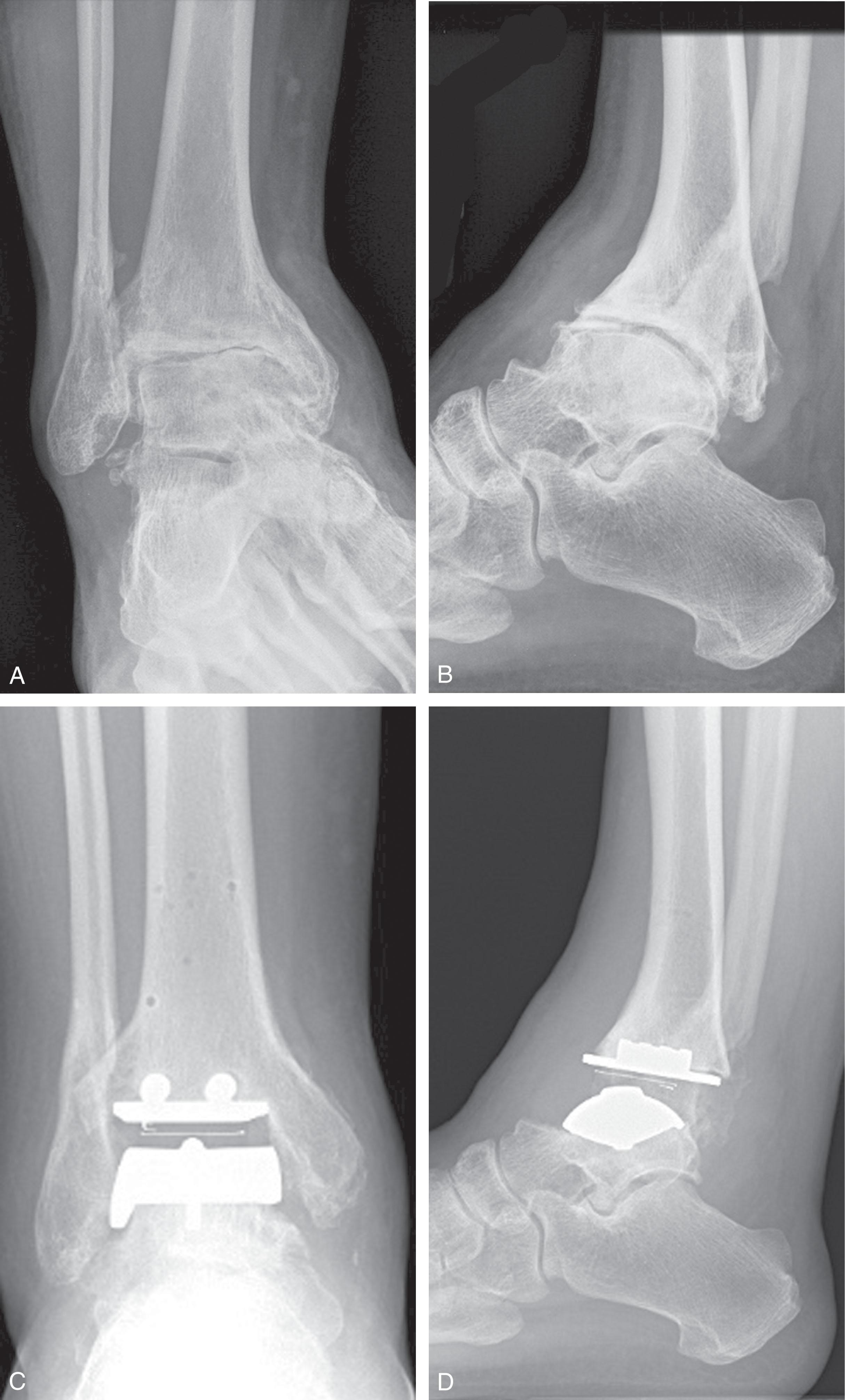 Fig. 23-15, Total ankle replacement (TAR) with preoperative sagittal plane deformity. A and B , Oblique and lateral radiographs showing posttraumatic ankle arthritis with a malunited distal tibia and fibula resulting in a sagittal plane deformity. C and D , Anteroposterior and lateral radiographs 1 year after TAR that managed the sagittal plane deformity but adjusting the distal tibial bone cut.