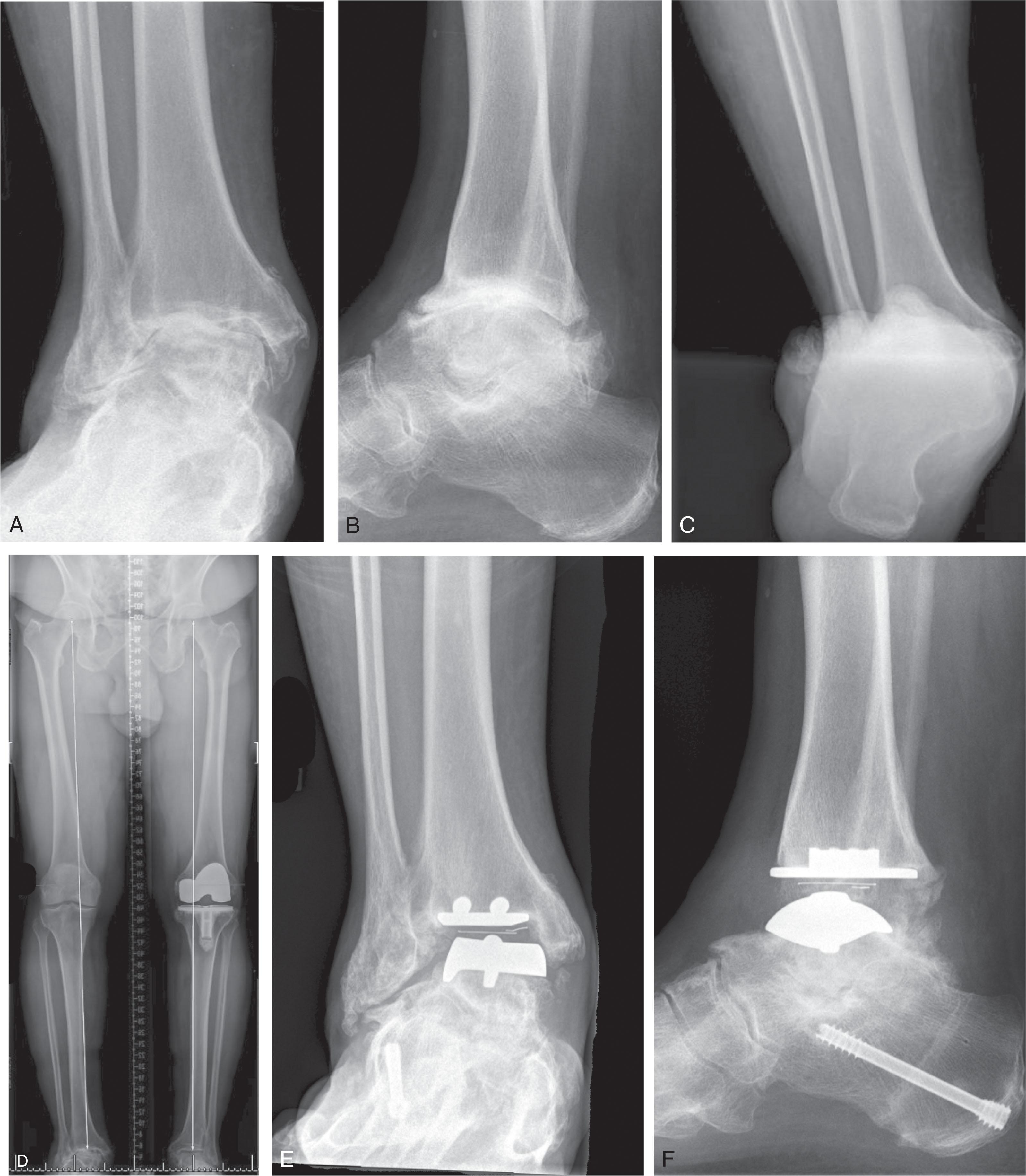 Fig. 23-16, Ankle malalignment related to planovalgus deformity. A and B , Anteroposterior and lateral radiographs of an arthritic ankle with valgus-incongruent coronal plane deformity. The lateral talar dome is eroding into the tibial plafond. C , Heel alignment radiograph showing severe valgus hindfoot alignment relative to the tibial shaft. D , Long-leg alignment radiograph showing neutral lower extremity alignment. E and F , Two years after ankle replacement and medial slide calcaneal osteotomy, mild intracomponent instability, and edge loading is seen.