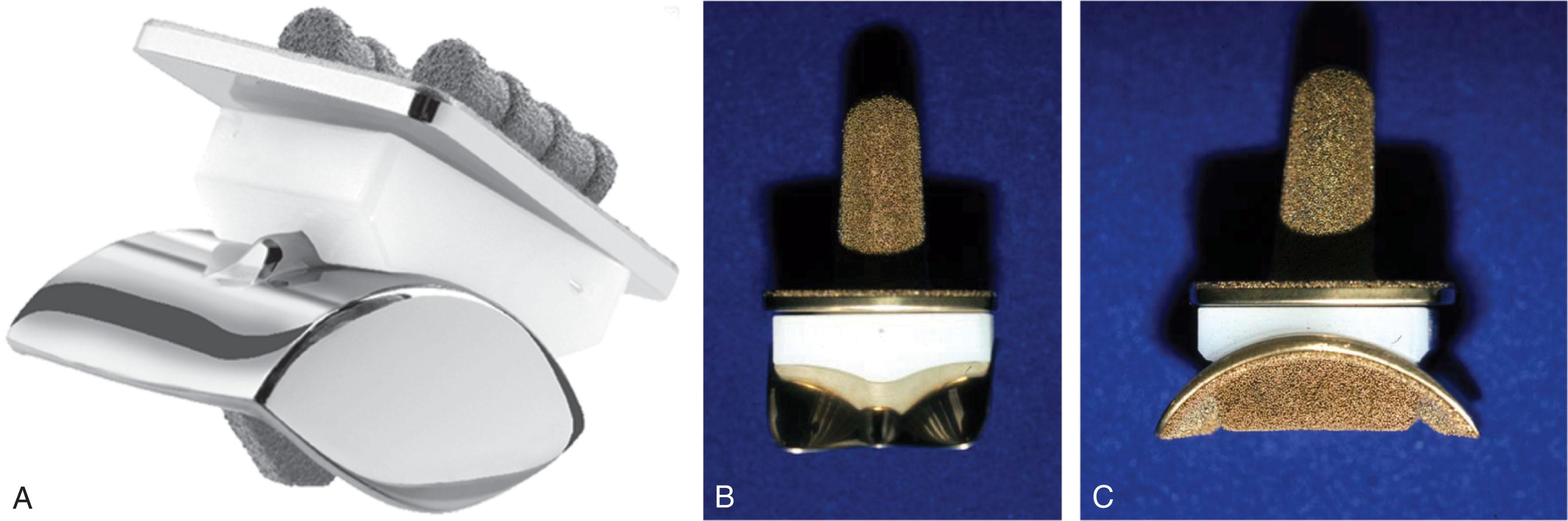 Fig. 23-4, Examples of second-generation total ankle replacements (TARs). These tended to be three-component with a mobile-bearing all-polyethylene insert. A , Scandinavian Total Ankle Replacement has a cylindrical congruent articulation between the polyethylene and talus with a matching groove. B and C , Buechel-Pappas TAR has a deep sulcus into the talus component rather than a raised ridge.