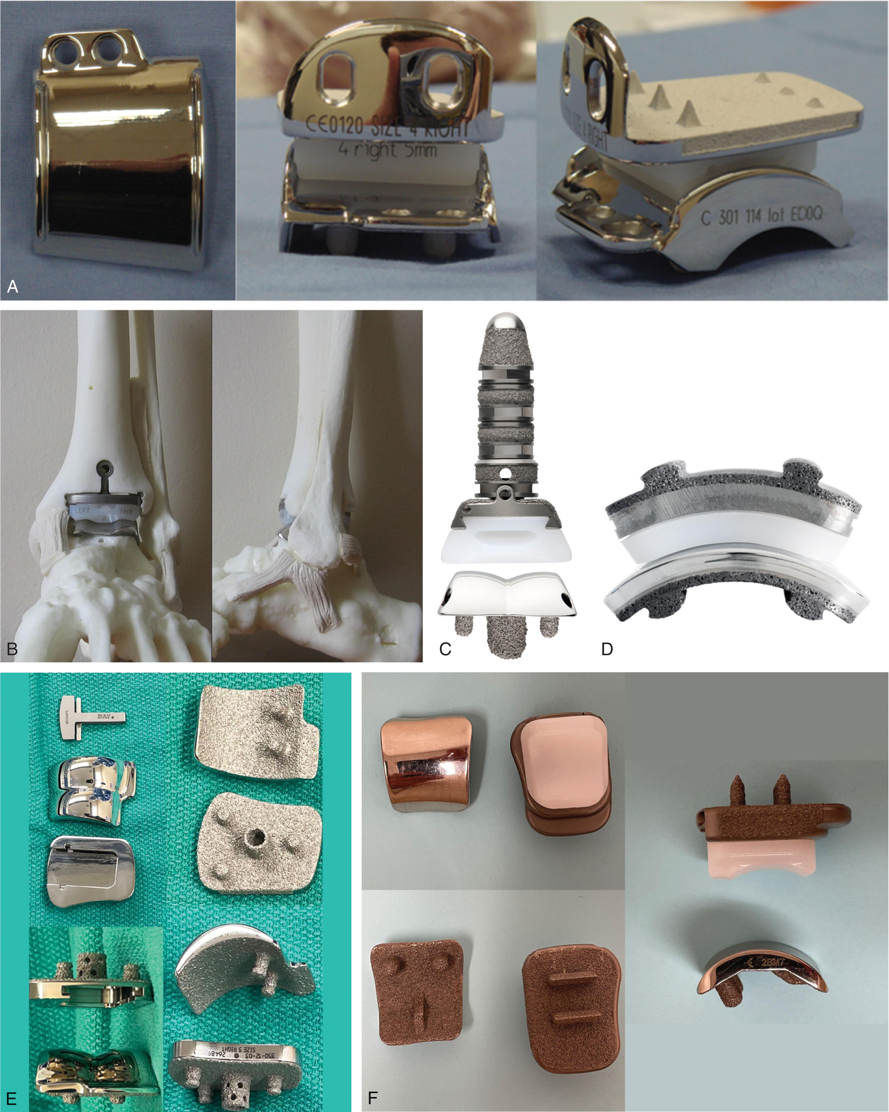 Fig. 23-5, Examples of third-generation total ankle replacements (TAR). These continued to improve on the innovations of second-generation TAR with particular emphasis on more closely matching ankle anatomy. Both two- and three-component designs are included in this group. A , HINTEGRA TAR talus has a differential curvature of radius medially and laterally to more closely match ankle kinematics. B , Salto Talaris TAR is a two-component design with a similar anatomically contoured talus component. C , INBONE TAR included a stem to the tibia and talus to augment fixation. D , The Trabecular Metal TAR uses a lateral approach to create cylindrical bone-metal interfaces at the tibia and talus. E , Vantage TAR is a two-component design incorporating a small cage to augment tibial fixation and a cylindrical talar design implanted from an anterior approach. F , Axiom TAR is a two-component design with features designed to match ankle kinematics.