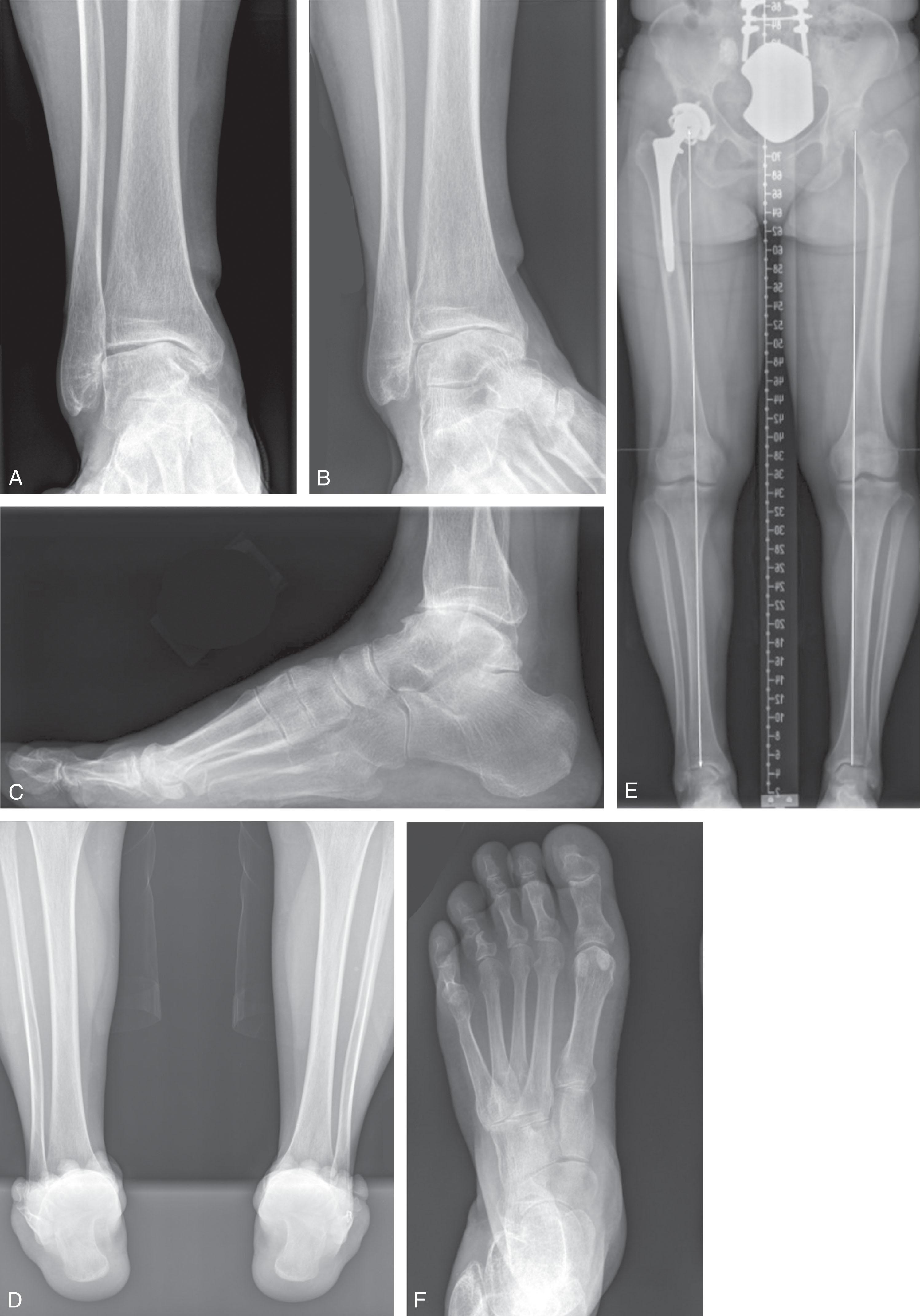 Fig. 23-6, Standard radiographs for evaluating ankle arthritis. A to C , Weight-bearing anteroposterior, oblique, and lateral ankle radiographs demonstrating posttraumatic ankle arthritis. D , Weight-bearing hindfoot alignment view. E , Weight-bearing hip to ankle alignment view. F , Weight-bearing anteroposterior foot view.