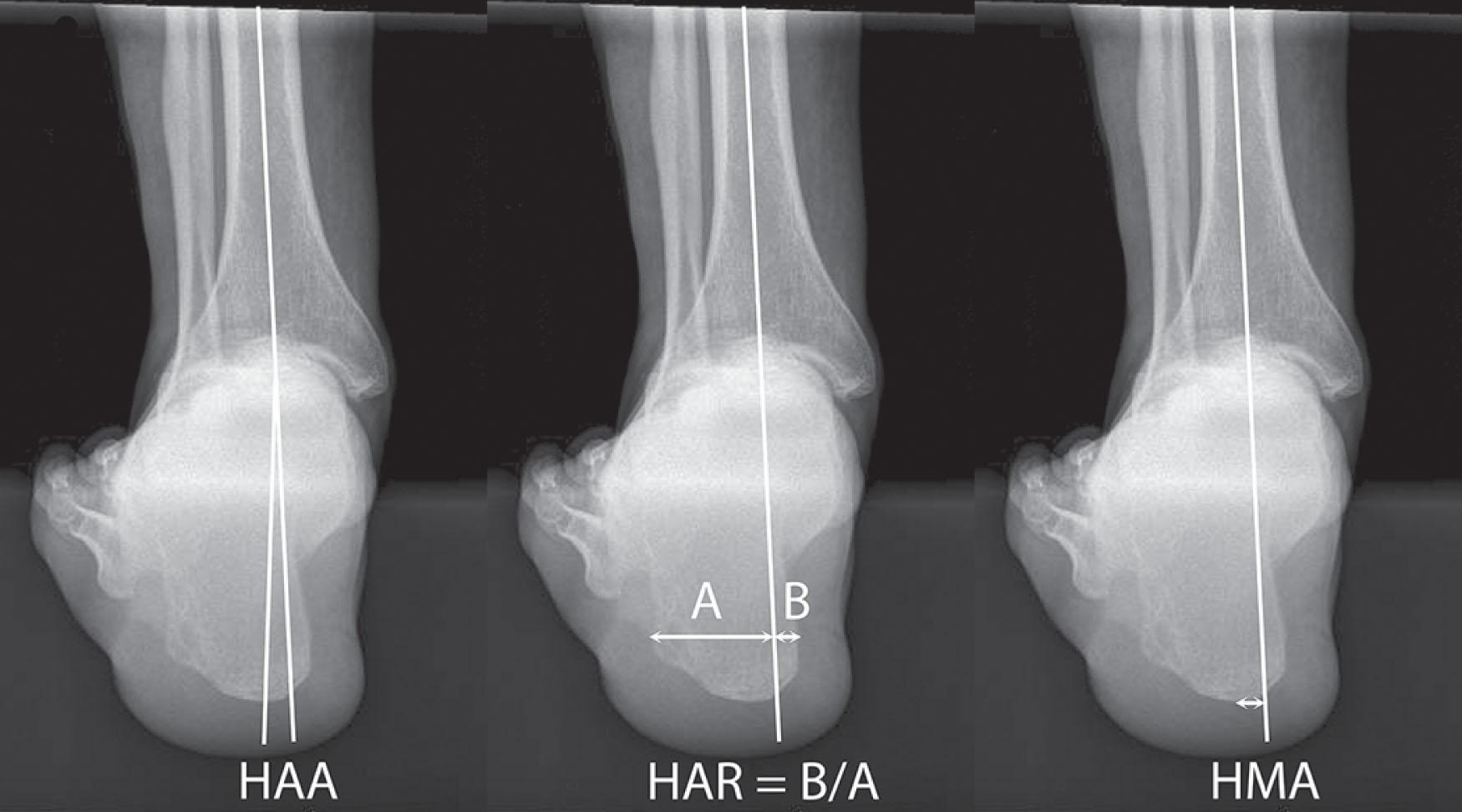 Fig. 23-7, Hindfoot alignment view measurements. Measurements taken from the hindfoot alignment view include the hindfoot alignment ankle (HAA) , hindfoot alignment ratio (HAR) , and the hindfoot moment arm (HMA) .