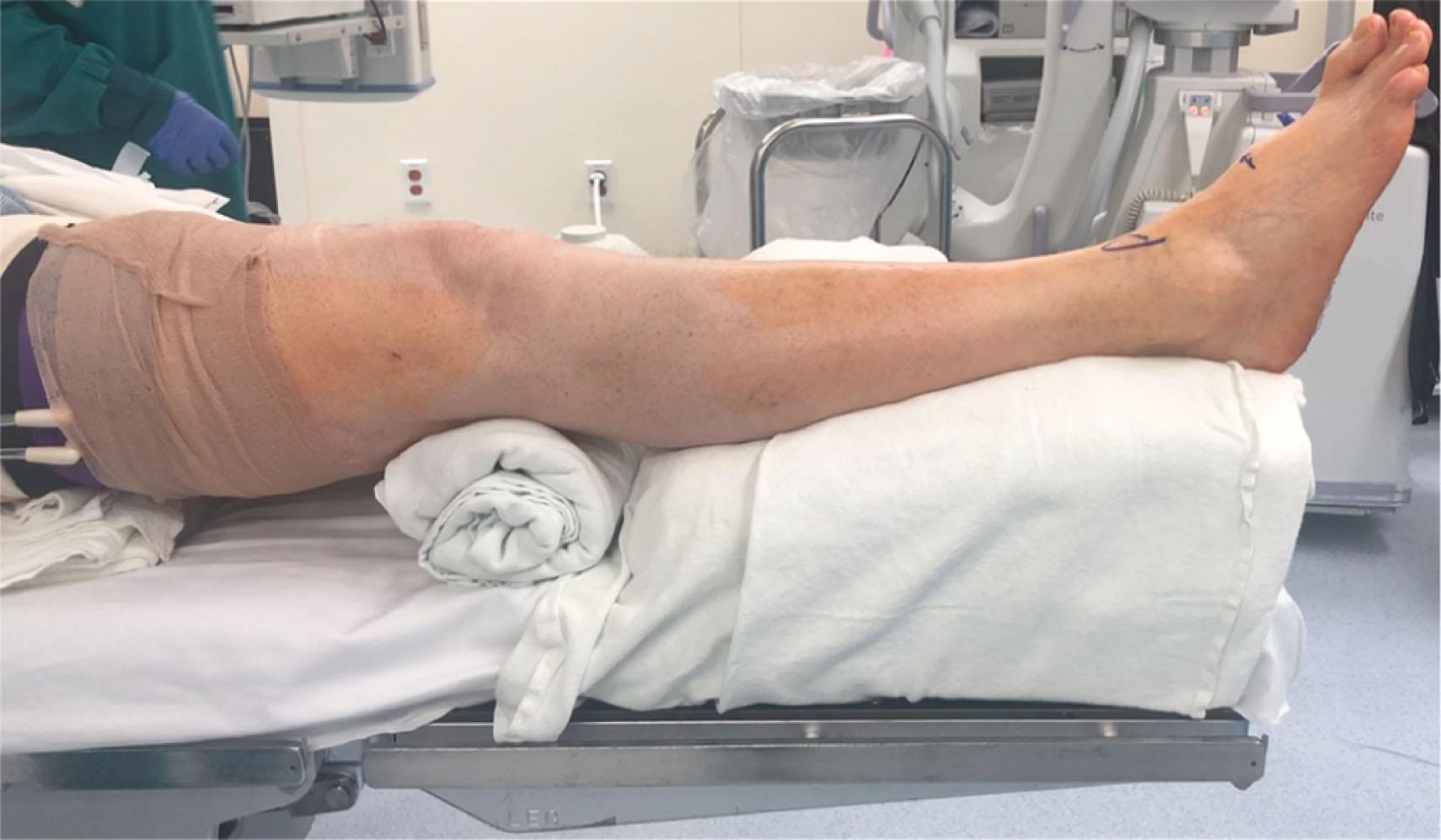 Fig. 23-8, Patient positioning for total ankle replacement. The leg is elevated on a short, padded platform with a thigh tourniquet and bump under the hip to rotate the ankle mortise into an upright position. The heel is at the end of the bed. Fluoroscopy is brought in from the opposite side.