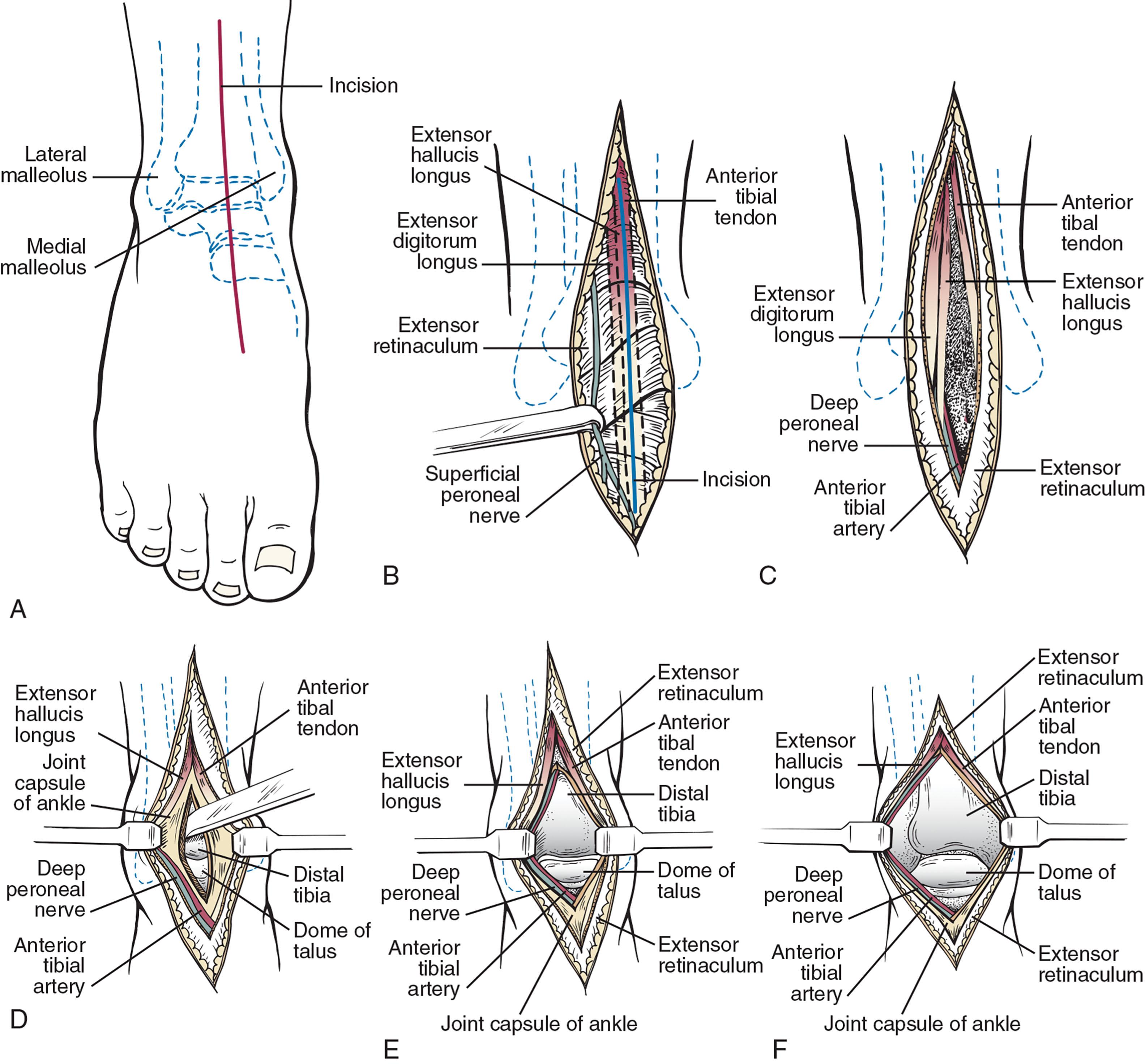 Fig. 23-9, Anterior approach to the ankle. A , A 10-cm longitudinal incision is made anteriorly between the palpable tibialis anterior (TA) and extensor hallucis longus (EHL) tendons. B , The medial branch of the superficial peroneal nerve is often encountered and gently retracted laterally. C , The extensor retinaculum between the TA and EHL is incised, the tendons bluntly separated, and the deep neurovascular structures are retracted laterally. Medially directed veins may be cauterized. D , The joint capsule is incised longitudinally and preserved for later closure. E , Subperiosteal dissection allows visualization of the anterior tibiotalar. F , Continued dissection from medial to lateral gutter allows complete visualization of the anterior tibiotalar joint.