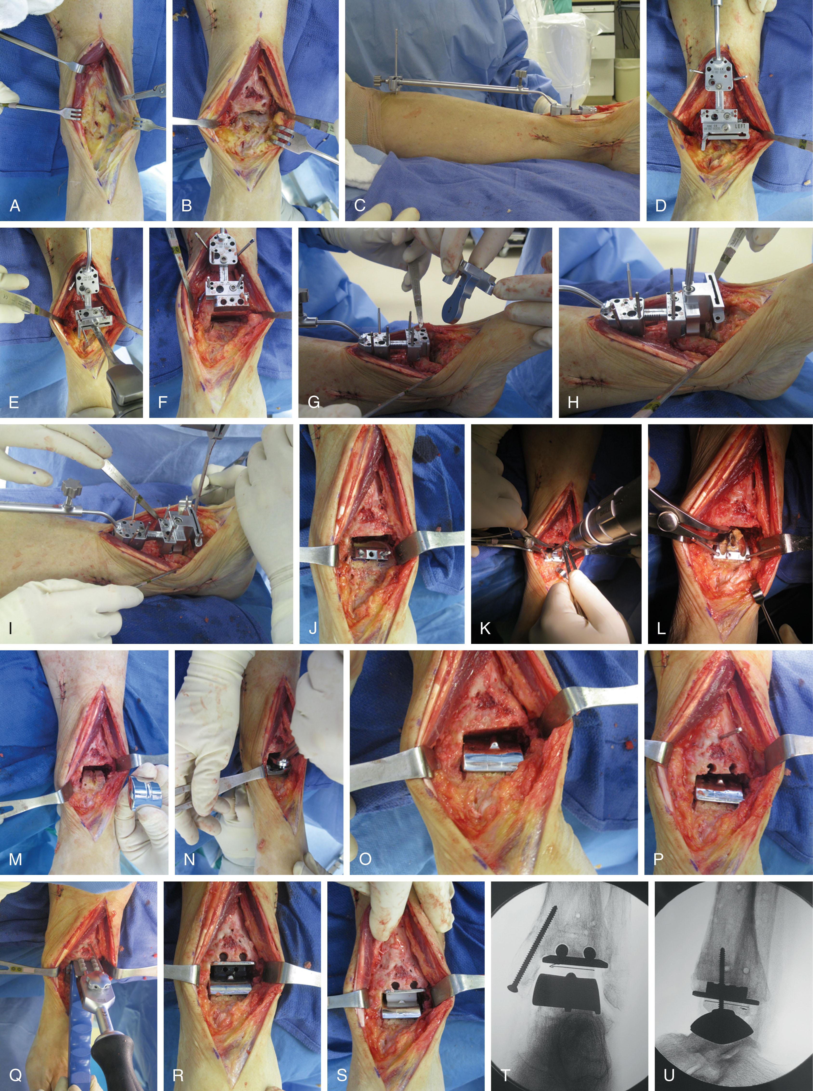 Fig. 23-10, A clinical example of the anterior surgical approach is shown for the Scandinavian Total Ankle Replacement. A , The anterior surgical approach is used. B , The ankle joint is exposed. The osteophytes on the anterior aspect of the tibia and the talar neck are to be removed. C , The guide is centered at the tuberosity of the tibia and the center of the ankle joint. D , The adjustable cutting block is applied in the correct position. E and F , the tibial cut is performed. G and H , Talar cutting block is applied in the correct position and horizontal talar cut ( I ) is performed. J , Separate guide block is applied and fixed to the top of the talus for removal of the medial and lateral sides of the talar body. K and L , The groove for anchoring the keel of the talar component is prepared with a drill. M to O , First, the talar component is positioned in press-fit technique. P to R , Then, the tibial component is positioned. S , Finally, an inlay is inserted between both metallic components. T and U , Final fluoroscopic check shows appropriate position of prosthesis components.