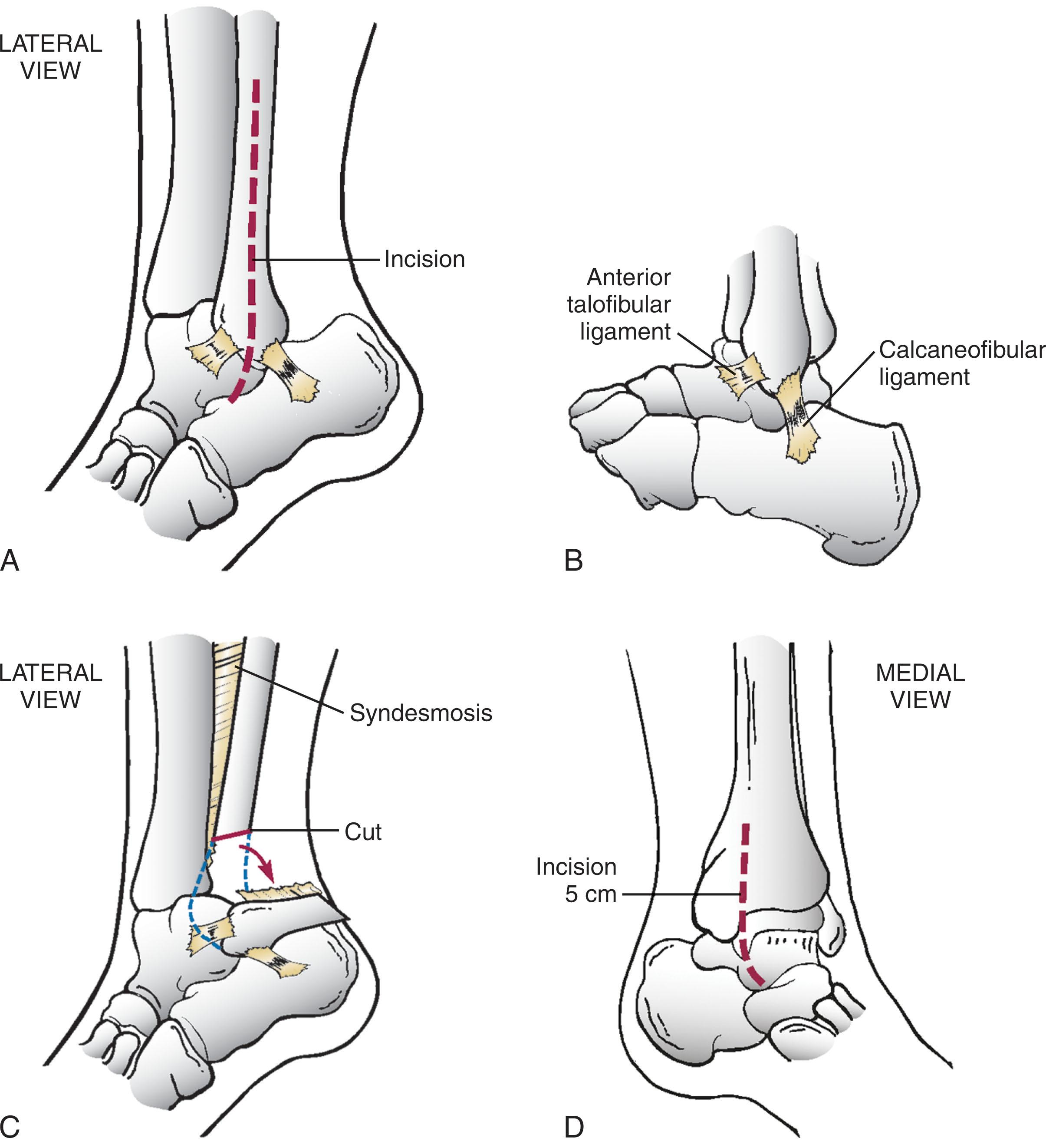 Fig. 23-11, Lateral approach to the ankle. A , A midline incision of the fibula of about 20 cm is used. B , The anterior talofibular ligament is identified and transected for the exposure. C , An oblique osteotomy of the distal fibula ending 10 to 15 mm above the joint. D , A secondary medial approach over the medial gutter.