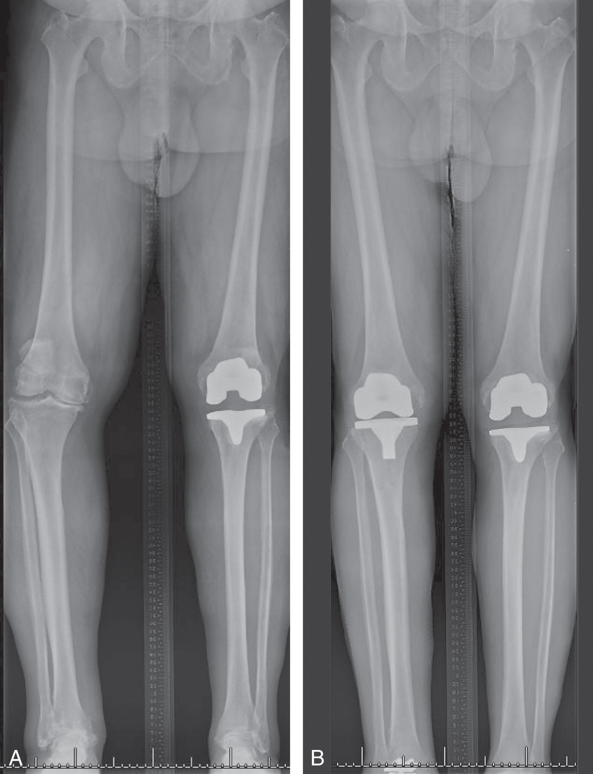 Fig. 23-12, Ankle malalignment related to genu varum. A , Hip to ankle anteroposterior radiograph showing ankle malalignment related to genu varum secondary to knee osteoarthritis. B , Hip to ankle anteroposterior radiograph after concurrent total knee and total ankle arthroplasty showing normalized limb alignment and well-placed knee and ankle prostheses.