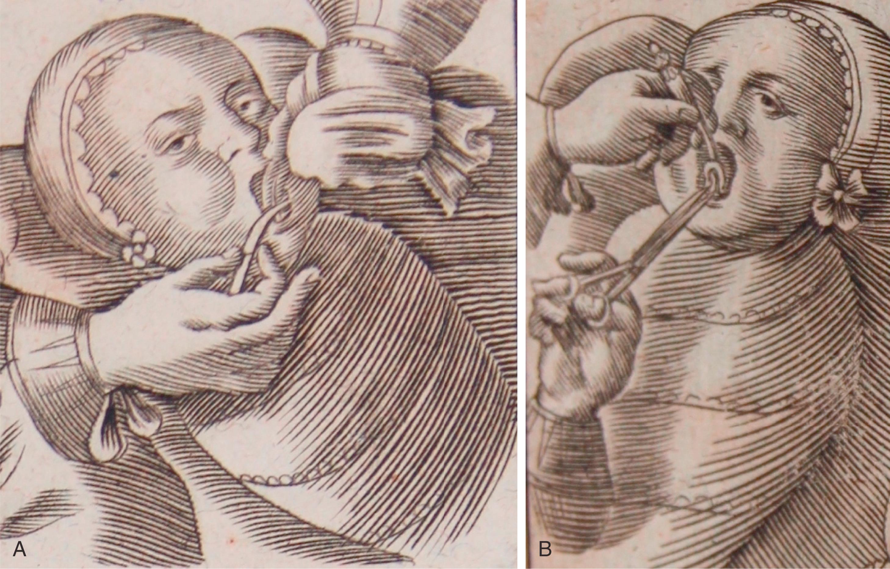 Fig. 33.1, Woodcuts from a surgical textbook showing frenotomy. (A) “We see the form used by Hieronymus Fabricius ab Acquapendente in which the tongue is held with a handkerchief and the band loosened with a little knife shaped like a sickle.” (B) “How the surgeon lifts the tongue with a little silver instrument and then with a sharp little scissor cuts apart the band that is attached too far.”