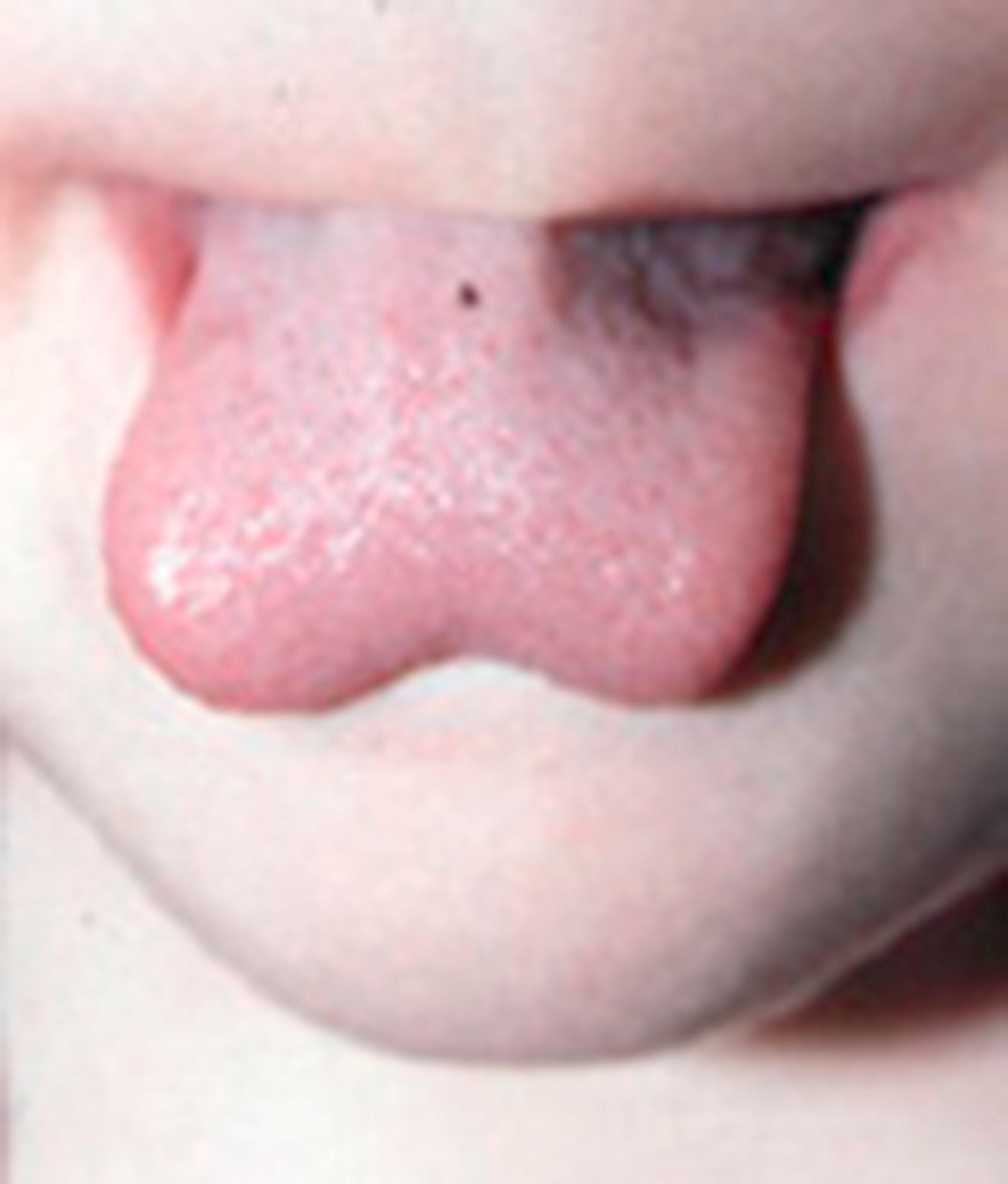 Fig. 33.2, Child with ankyloglossia who is maximally protruding his tongue. Note the heart shape.