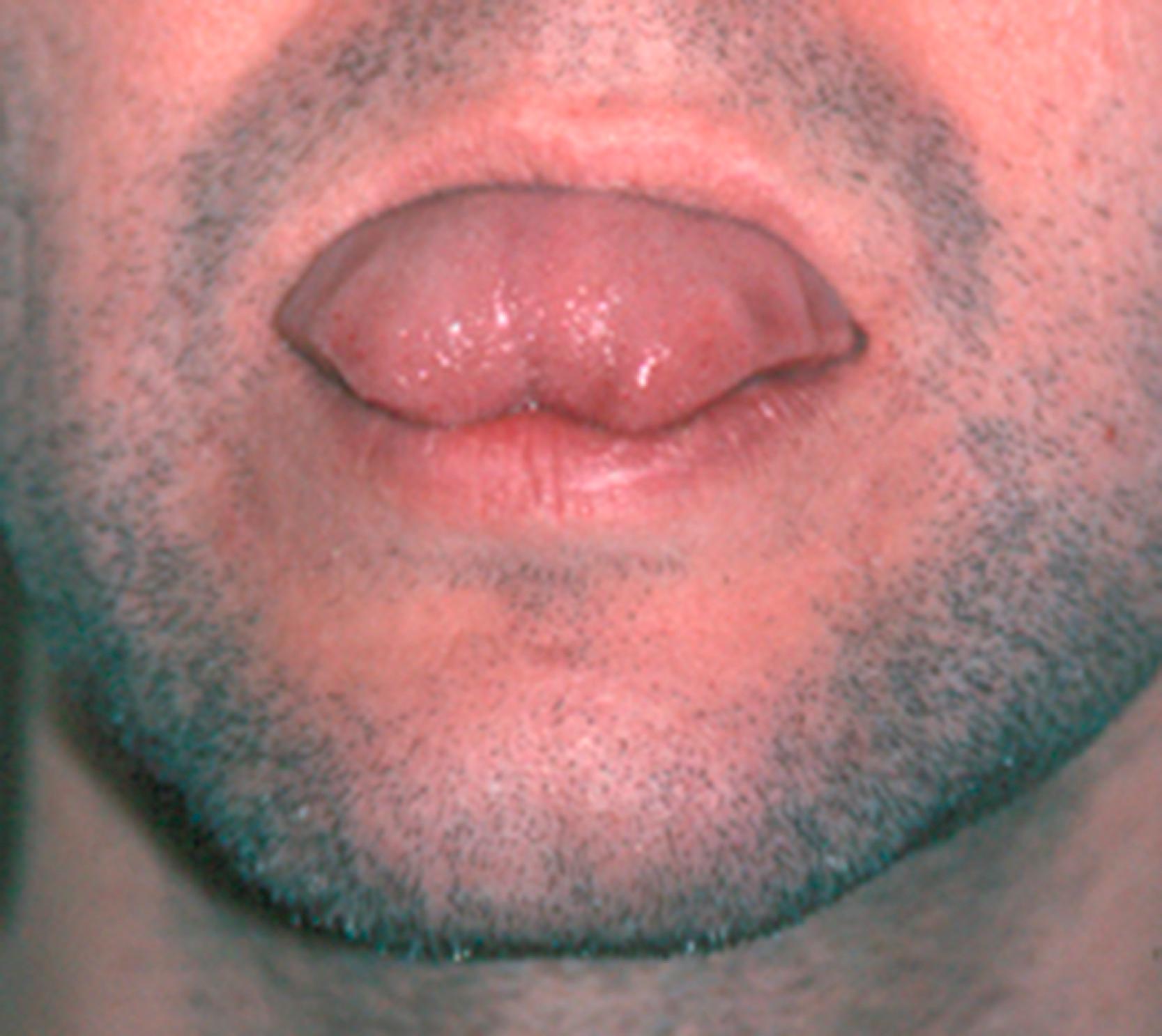 Fig. 33.3, Severe ankyloglossia in an adult shows inability to protrude the tongue.