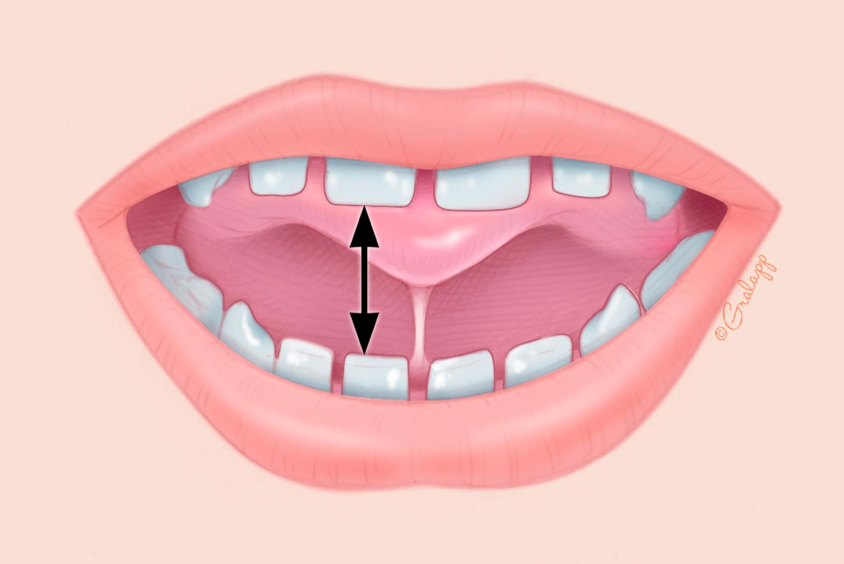 Fig. 33.4, Interincisal distance. The tongue tip is placed behind the upper incisors and the mouth opened maximally. The distance between the midline incisor teeth is the “interincisal distance.”