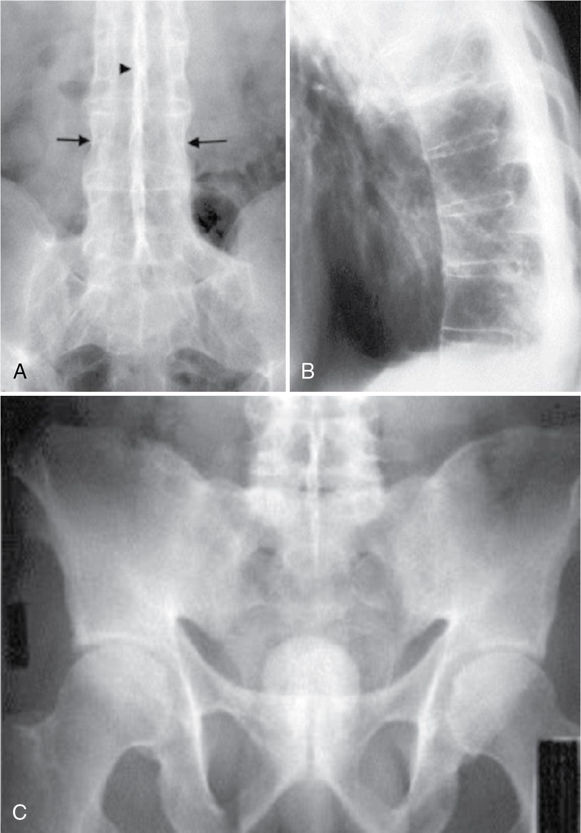 Fig. 68.1, Ankylosis of the lumbar spine in a patient with ankylosing spondylitis.