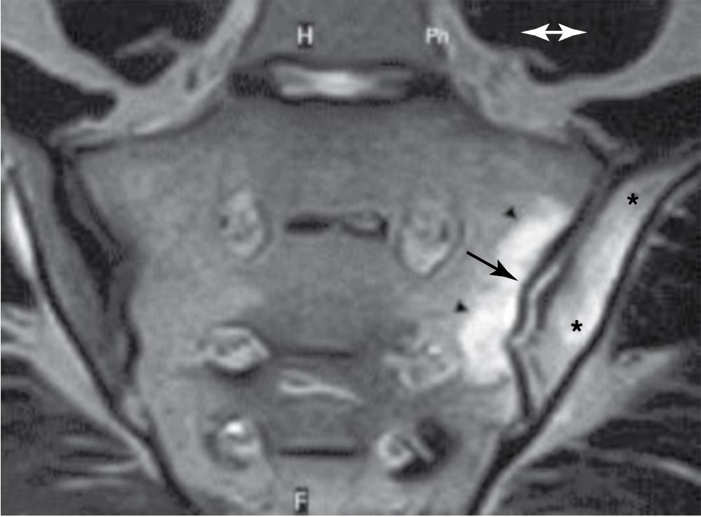Fig. 68.2, Coronal fat saturation fast-spin echo (FSE) T2-weighted image shows increased periarticular signal about the left sacroiliac joint (arrowheads and asterisks) consistent with bone marrow edema and increased signal within the sacroiliac joint (black and white arrows) . These findings correlated with active left sacroiliitis in this patient with ankylosing spondylitis.