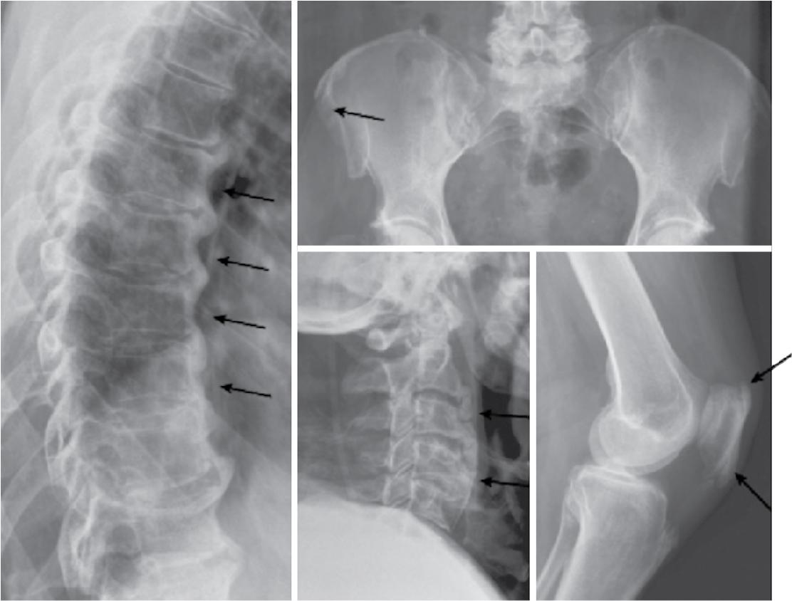 Fig. 68.3, Diffuse idiopathic skeletal hyperostosis (DISH) is seen in older individuals, predominantly, involving the thoracic spine with flowing anterior ossification (at least four levels) and associated with enthesophytes elsewhere (especially pelvis). Patients are at increased risk for heterotopic bone formation after joint replacement. Differentiated from ankylosing spondylitis by age (older); location (C, T spine > L spine, no sacroiliac involvement); and morphology (loosely flowing ossification on lateral view). Left image, lateral thoracic radiograph shows classic osteophyte pattern seen in DISH. Upper right image, anteroposterior pelvis radiograph shows pelvic enthesophyte. Center image, lateral cervical radiograph shows classic osteophyte pattern noted in DISH. Lower right image, lateral knee radiograph shows patella enthesophyte.