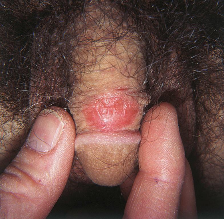 Fig. 73.11, Psoriasis of the penile shaft.