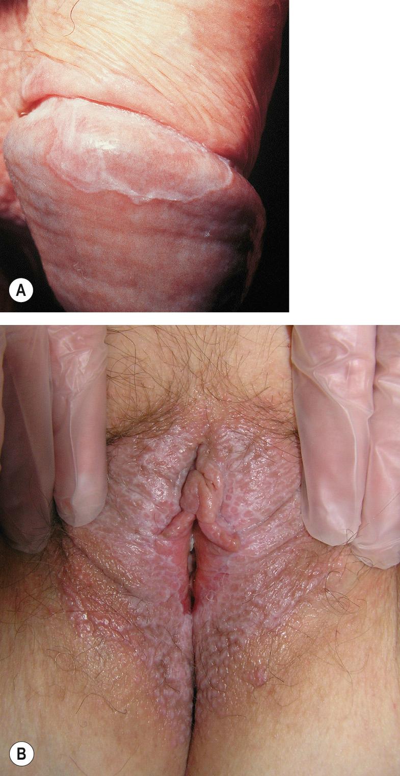 Fig. 73.6, Lichen planus.