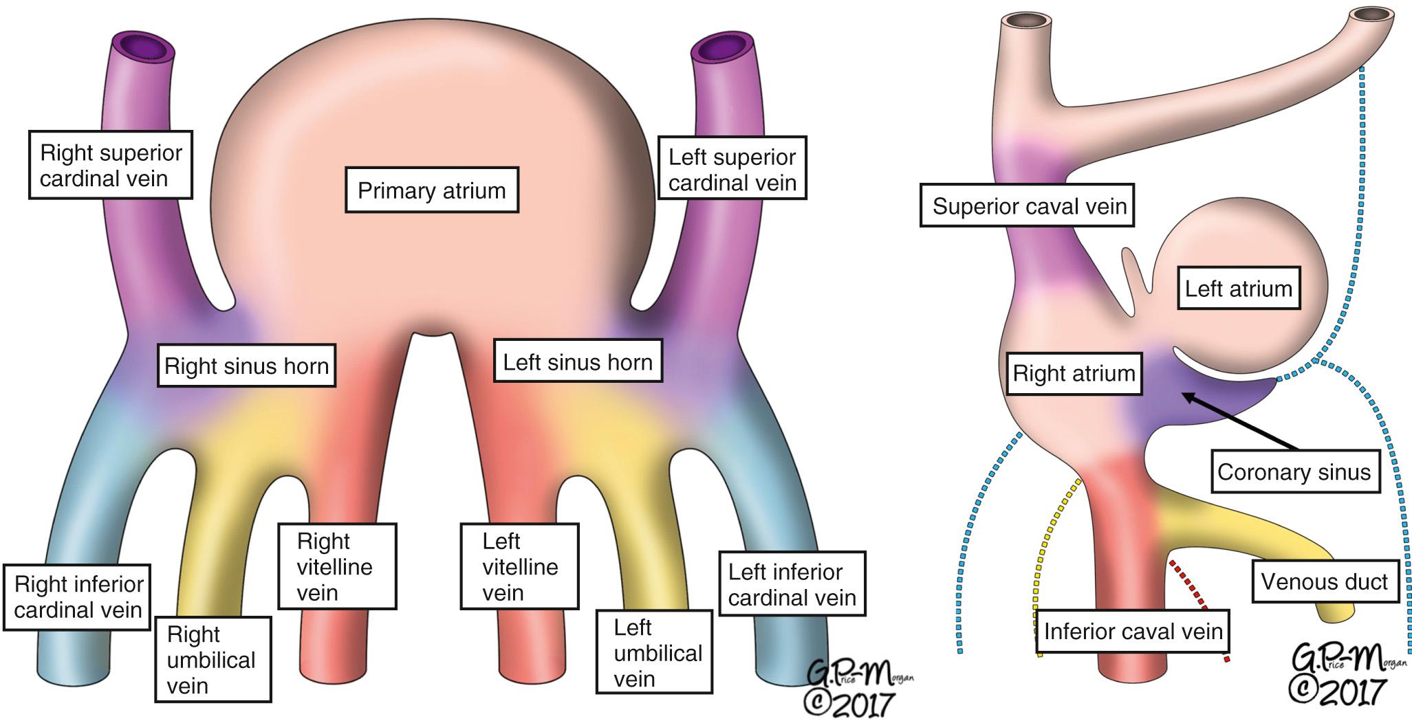 Fig. 27.1, How the bilaterally symmetric venous channels seen early during embryologic development (left) become converted into the postnatal situation in which the superior and inferior caval veins, along with the coronary sinus, drain to the systemic venous sinus of the morphologically right atrium (right) .