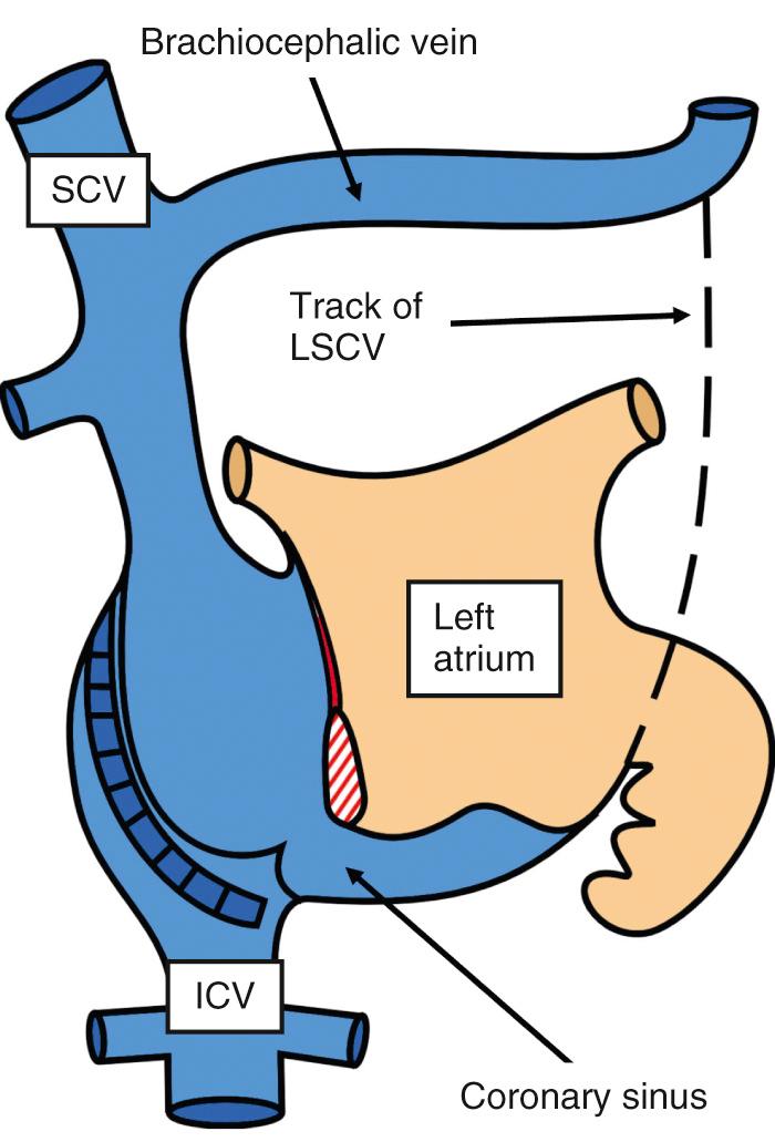 Fig. 27.3, Initial course of the left-sided superior cardinal vein draining to the left sinus horn (LSCV). This channel usually regresses but can persist as the left superior caval vein. Its remnant in the posterior wall of the left atrium is the oblique vein, along with the ligament of Marshall. ICV , Inferior caval vein; SCV , superior caval vein.