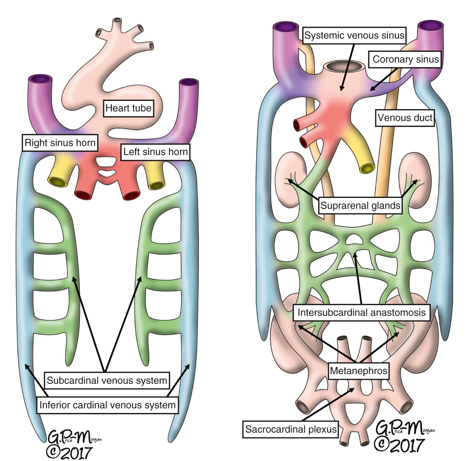 Fig. 27.4, Initial steps in formation of the inferior caval vein. Left, Initial arrangement in which the three venous channels drain bilaterally into the atrial component of the heart tube. (Compare with Fig. 27.1 ; the same coloring system is used to identify the venous components.) The initial step is formation of a subcardinal venous system. Right, This is followed by formation of the subcardinal anastomotic channels, along with the sacrocardinal plexus. These new components contribute to the formation of the renal and suprarenal venous systems as well as the abdominal component of the inferior caval vein.