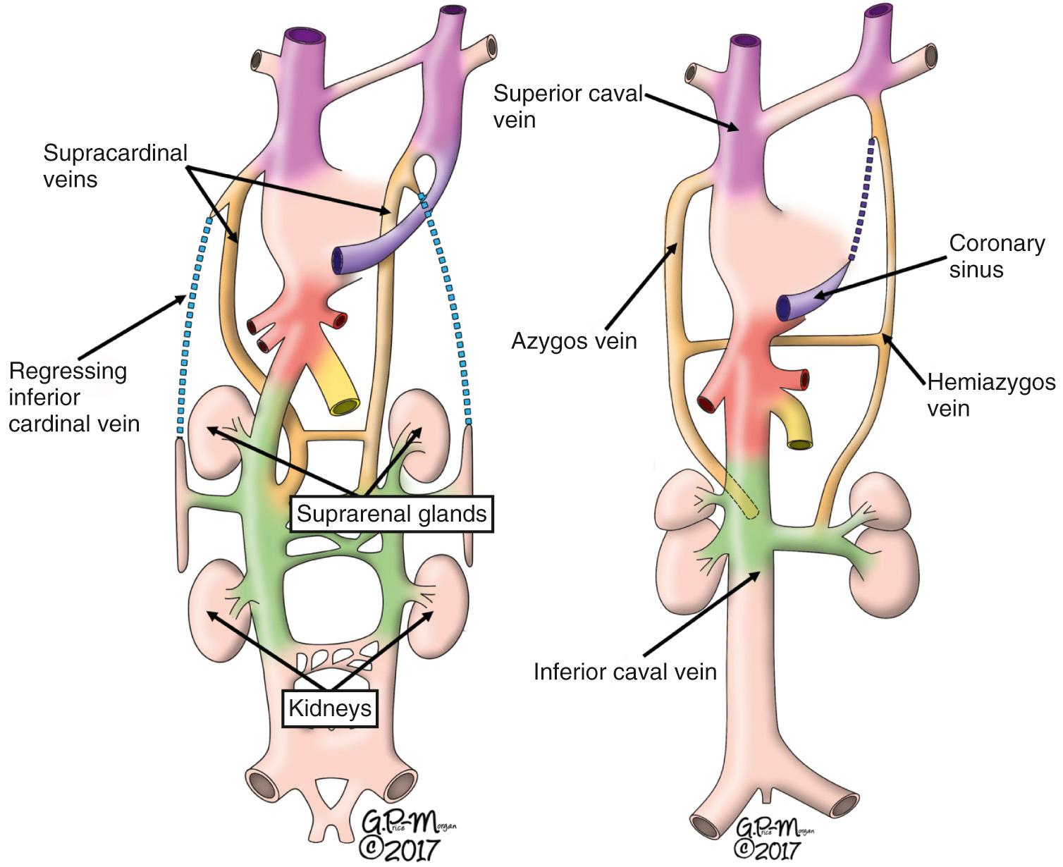 Fig. 27.5, Further changes that take place to provide the definitive inferior caval vein. Left, Formation of the supracardinal venous system, with regression of the inferior cardinal veins. Right, These supracardinal veins become the azygos and hemiazygos veins, while the definitive abdominal inferior caval vein drains to the right atrium via the initial right vitelline vein, with its abdominal components derived from the subcardinal and sacrocardinal venous plexuses.