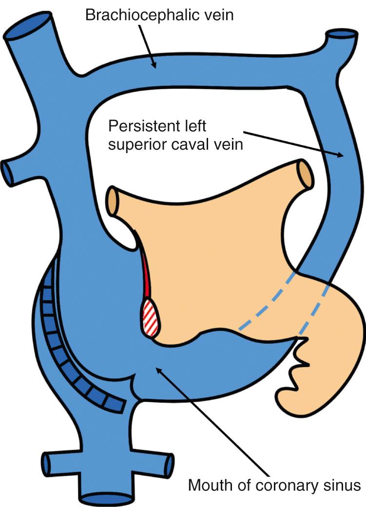 Fig. 27.6, Arrangement of persistence of the left superior caval vein in the presence of a connecting brachiocephalic vein. In this setting, the left-sided superior caval vein can be ligated, preferably after balloon occlusion testing.