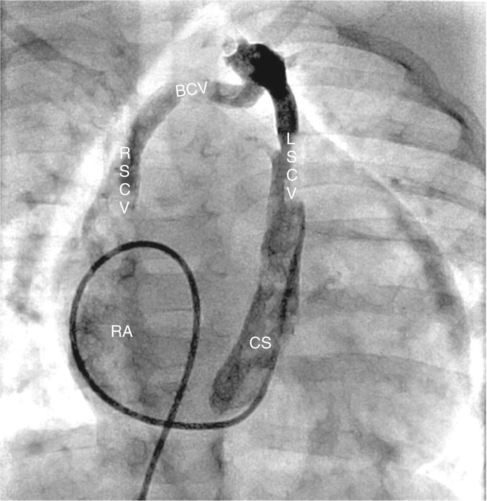 Fig. 27.7, Angiogram taken in a patient with bilateral superior caval vein showing the presence of a connecting brachiocephalic vein, which is of good size. When the left superior vein is also of good size, testing by inflating an occlusive balloon should be undertaken before considering ligation during surgical repair. CS , Coronary sinus; BCV, brachiocephalic vein; LSCV , left superior caval vein; RA , right atrium; RSCV , right superior caval vein.