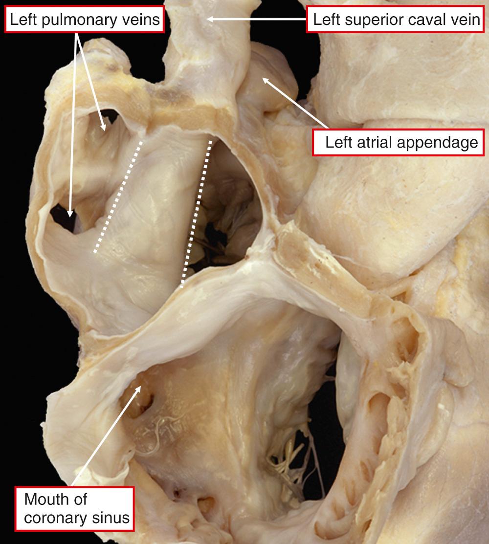 Fig. 27.8, Dissection showing the course of a persistent left superior caval vein ( dotted lines ) along the vestibule of the left atrioventricular junction. There is an obvious bulge into the cavity of the morphologically left atrium.