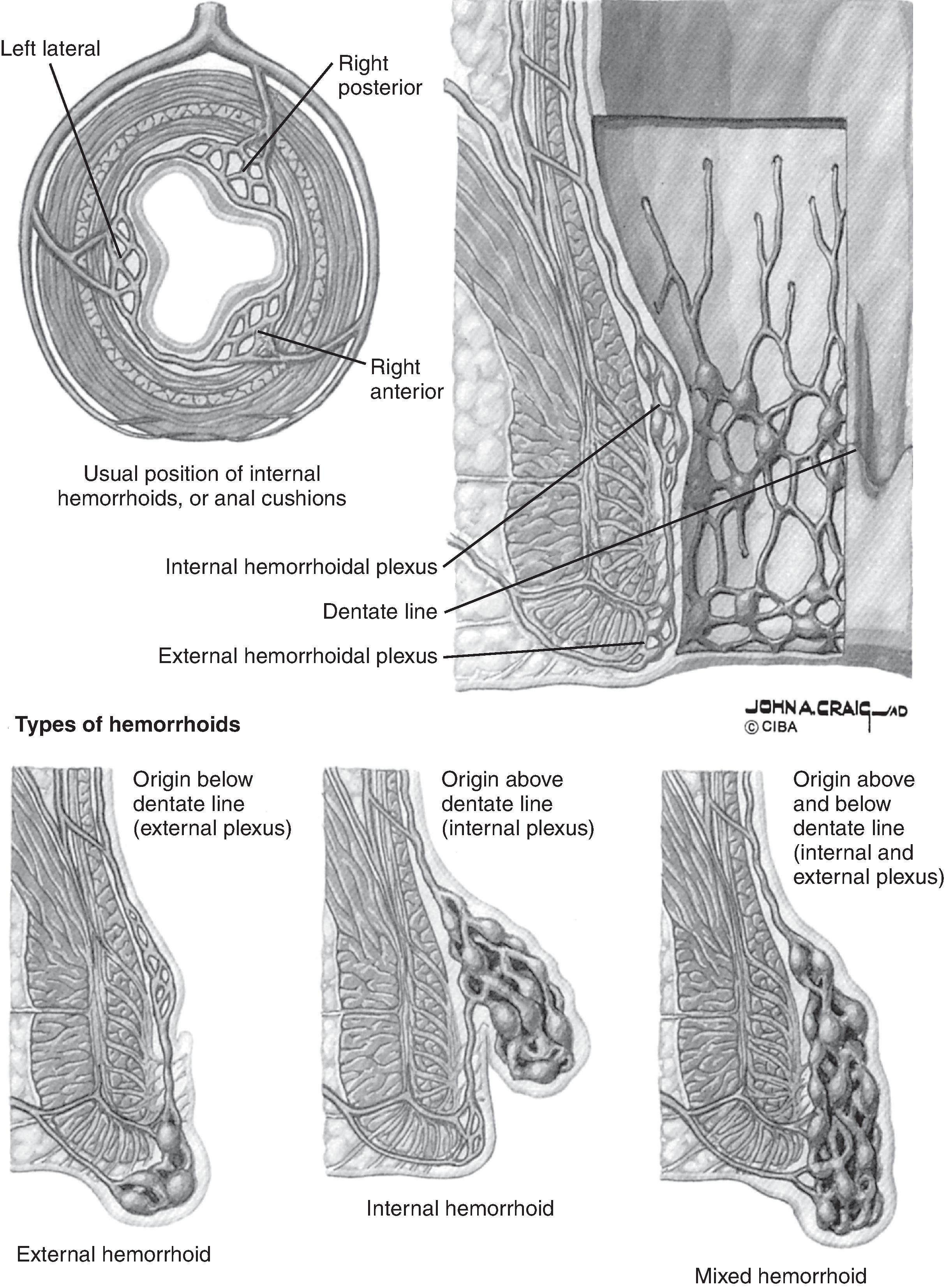 FIG. 1, Location and types of hemorrhoids.