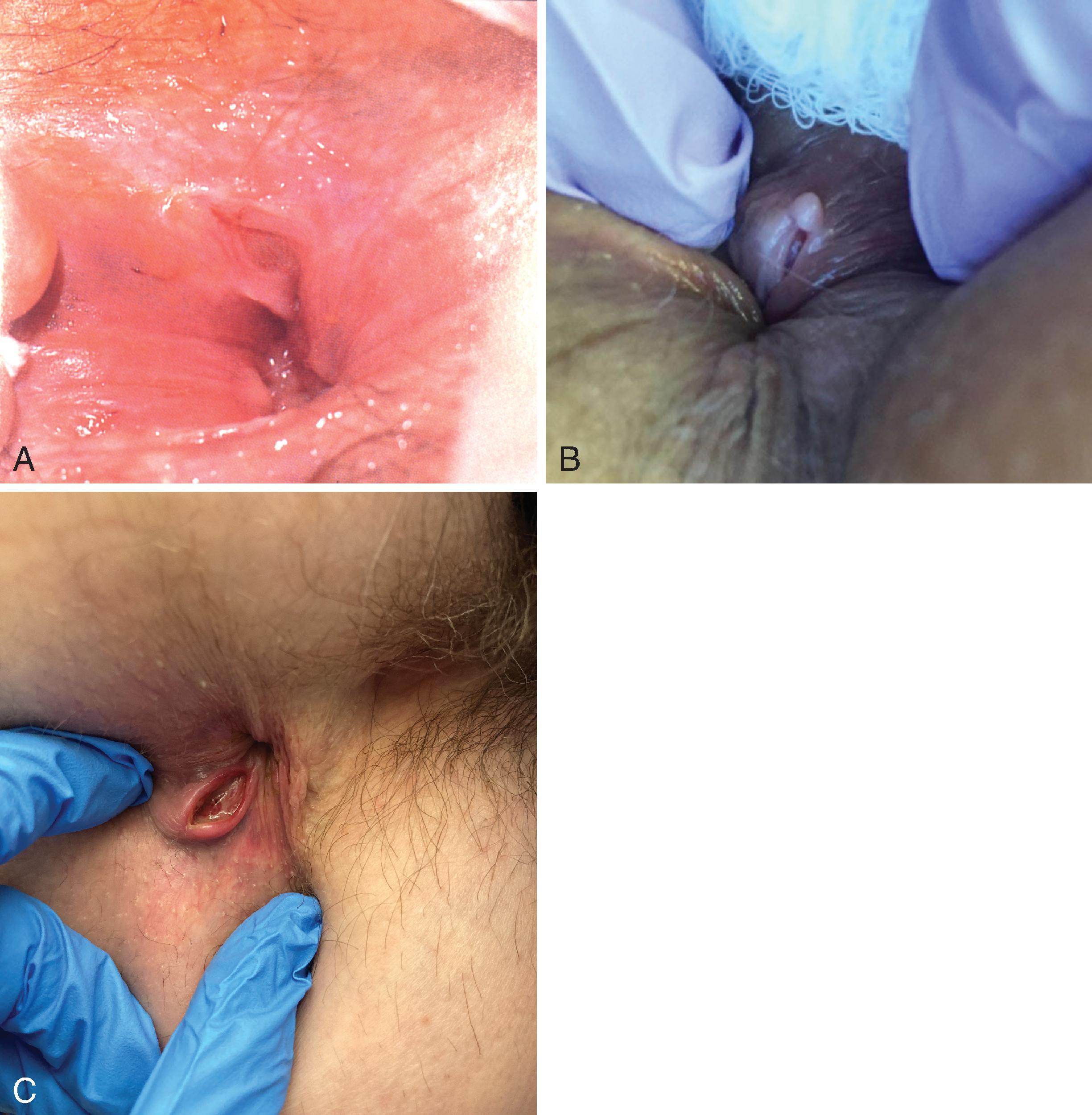 FIG. 1, (A) Acute posterior midline fissure. (B) Chronic fissure with sentinel tag. (C) Off-midline fissure associated with Crohn’s disease.