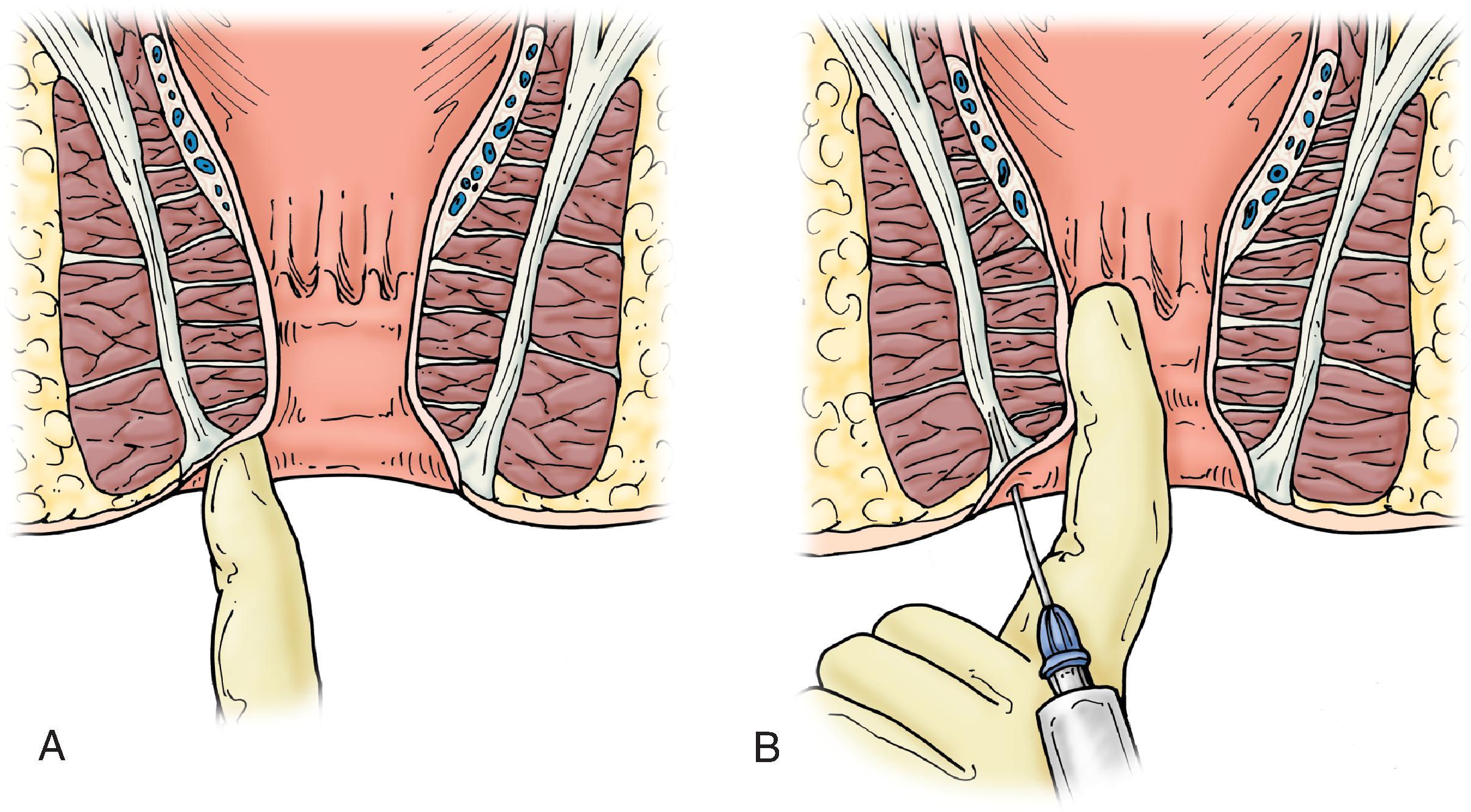 FIG. 2, Chemical denervation. (A) Palpation of the intersphincteric groove with a lubricated finger guides (B) injection in four quadrants. (From Braasch JW, Sedgwick CE, Veidenheimer MC, Ellis H, eds . Atlas of Abdominal Surgery. Philadelphia: Saunders; 1991:199)