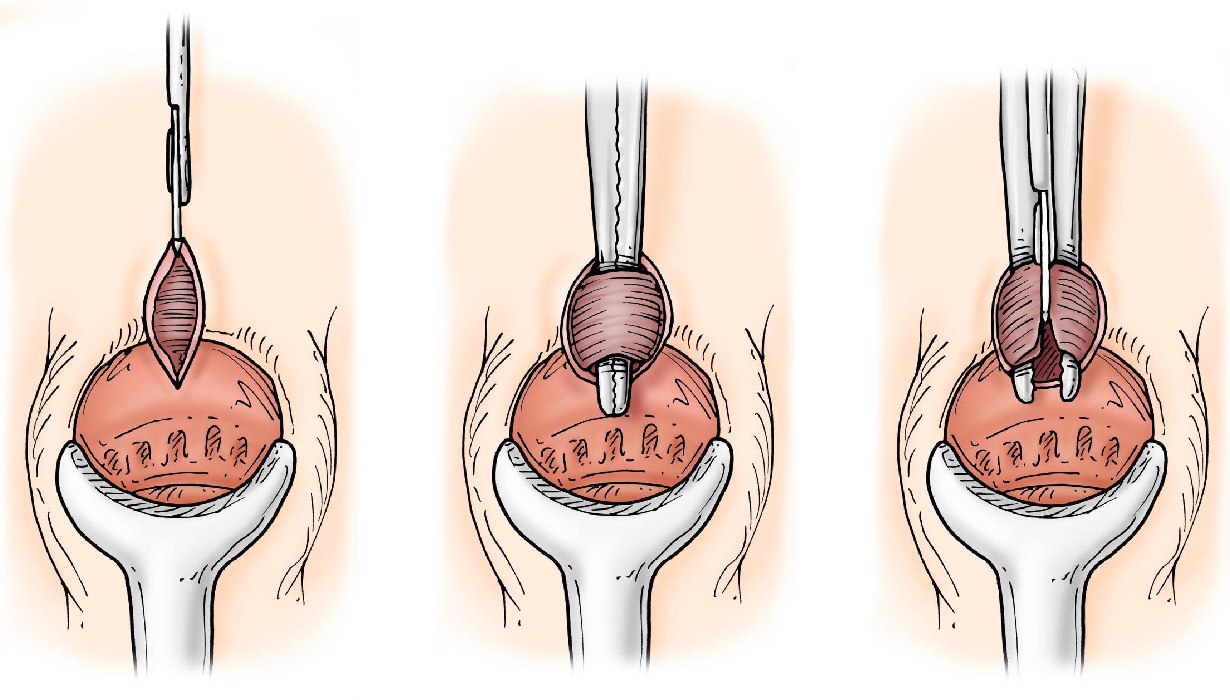 FIG. 3, Open lateral internal sphincterotomy. (From Wexner SW, Beck DE, eds . Fundamentals of Anorectal Surgery. 2nd ed. London: Saunders; 1998:214–215.)