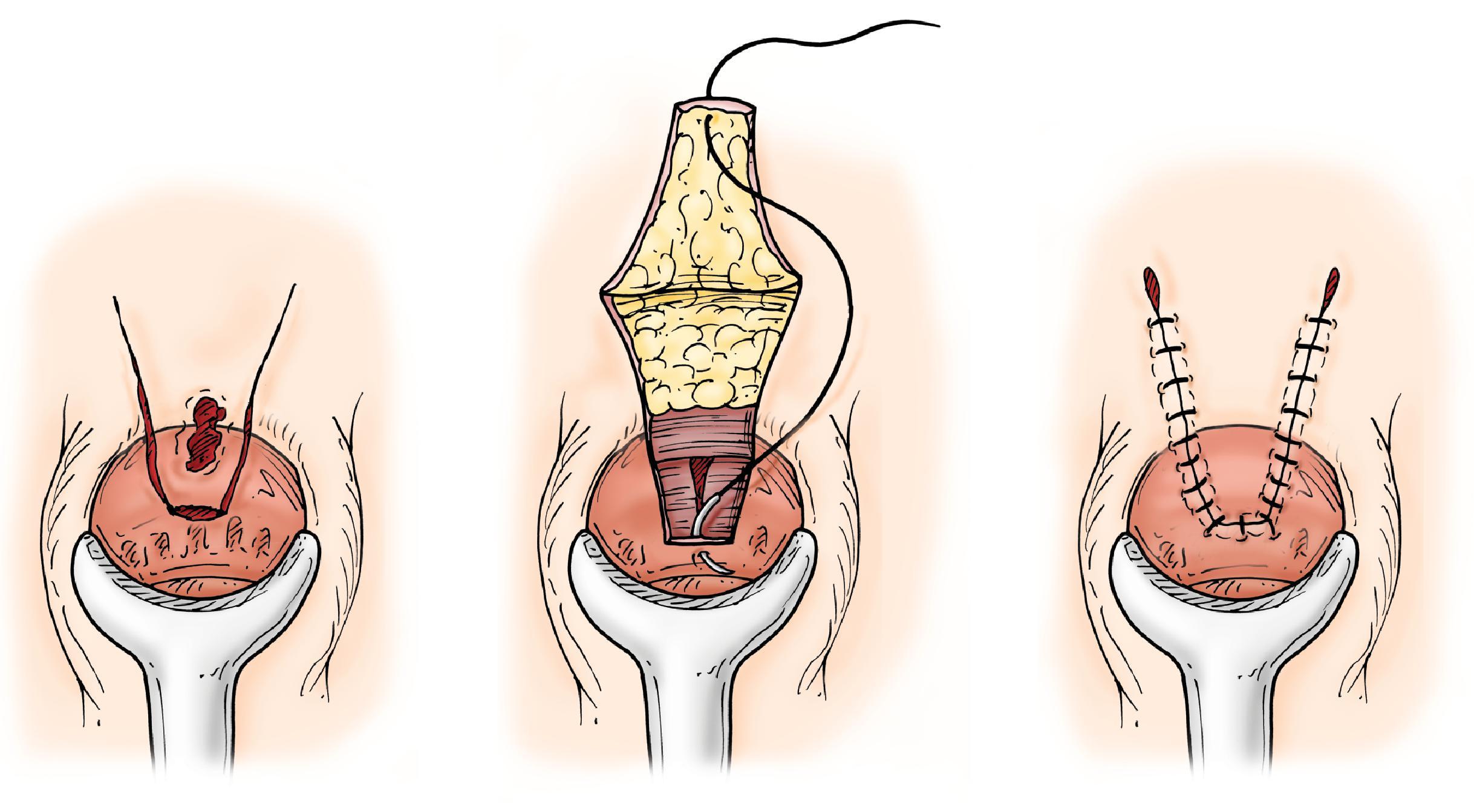 FIG. 5, V-Y advancement flap. (From Braasch JW, Sedgwick CE, Veidenheimer MC, Ellis H, eds . Atlas of Abdominal Surgery. Philadelphia: Saunders; 1991:199)