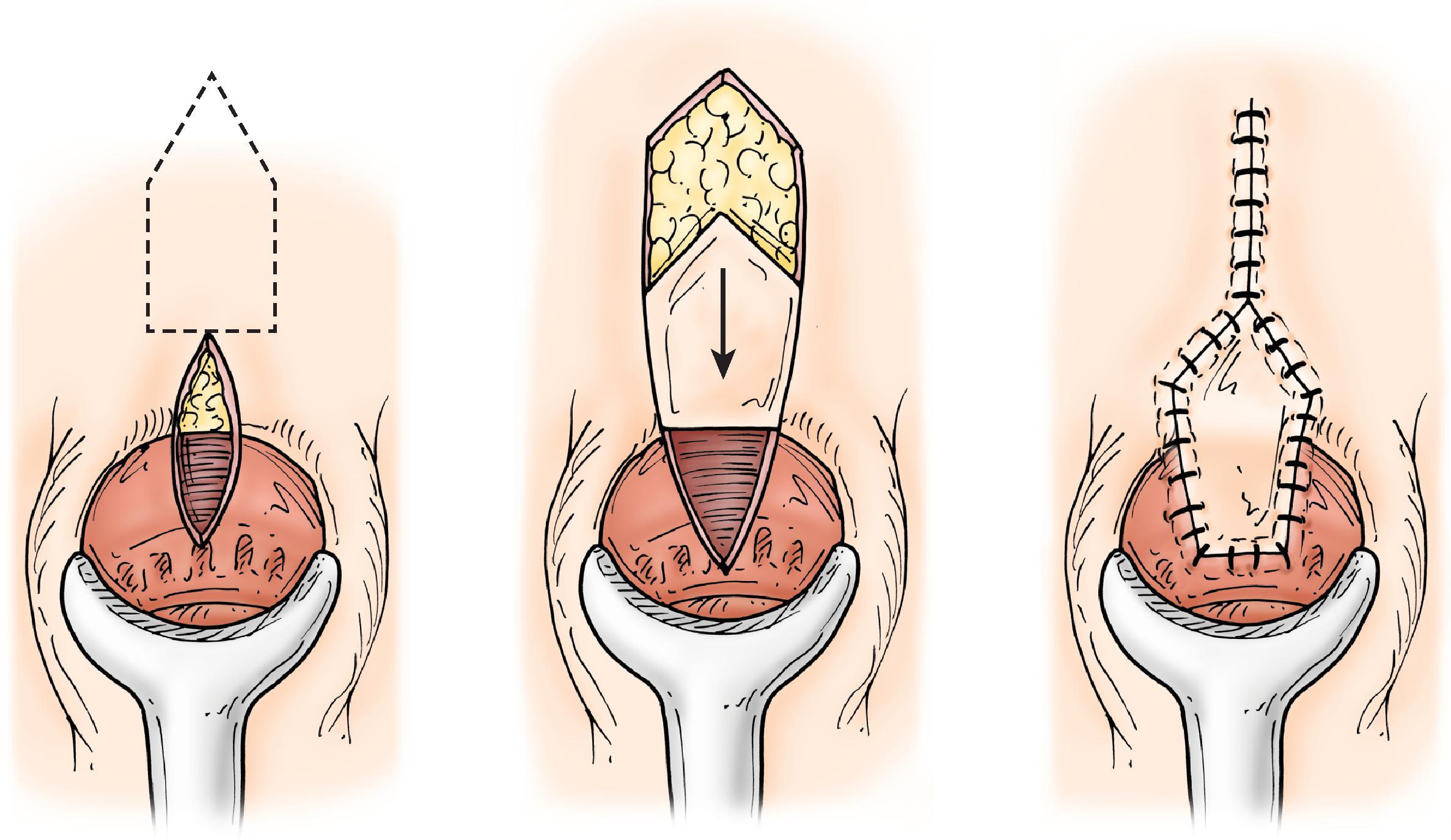 FIG. 6, House advancement flap. (From Liberman H, Thorson AG. How I do it. Anal stenosis . Am J Surg. 2000 Apr;179(4):325–9.)