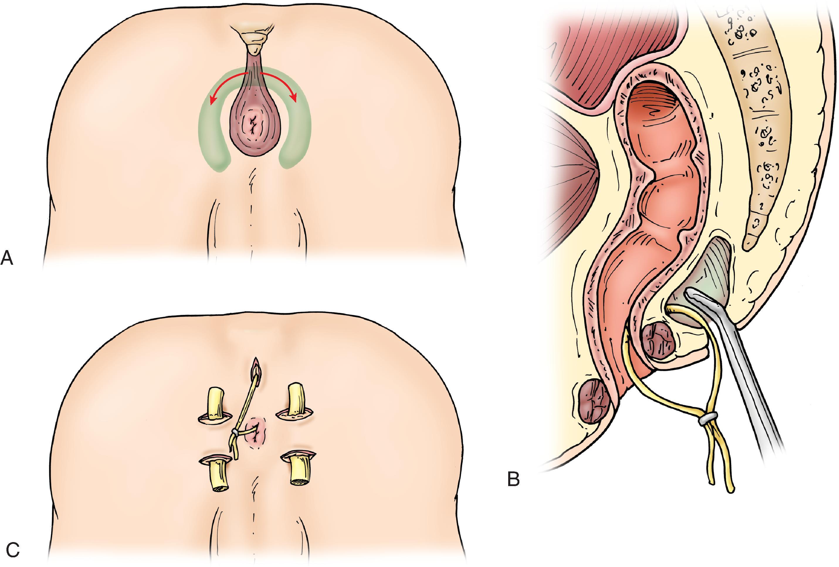 FIG. 2, (A) Horseshoe abscess shows that the deep postanal space is a window to the ischiorectal fossa bilaterally (arrows) . (B) The deep postanal space is drained through a radial incision in the posterior midline. A clamp is placed in the postanal space to ensure adequate drainage. If an internal opening is identified, a seton is placed through the fistula tract, encircling the posterior sphincter. (C) Counterincisions drain the ischiorectal fossa. Placement of Penrose drains through the tracts ensures adequate drainage of the abscess cavities without significant soft-tissue loss.