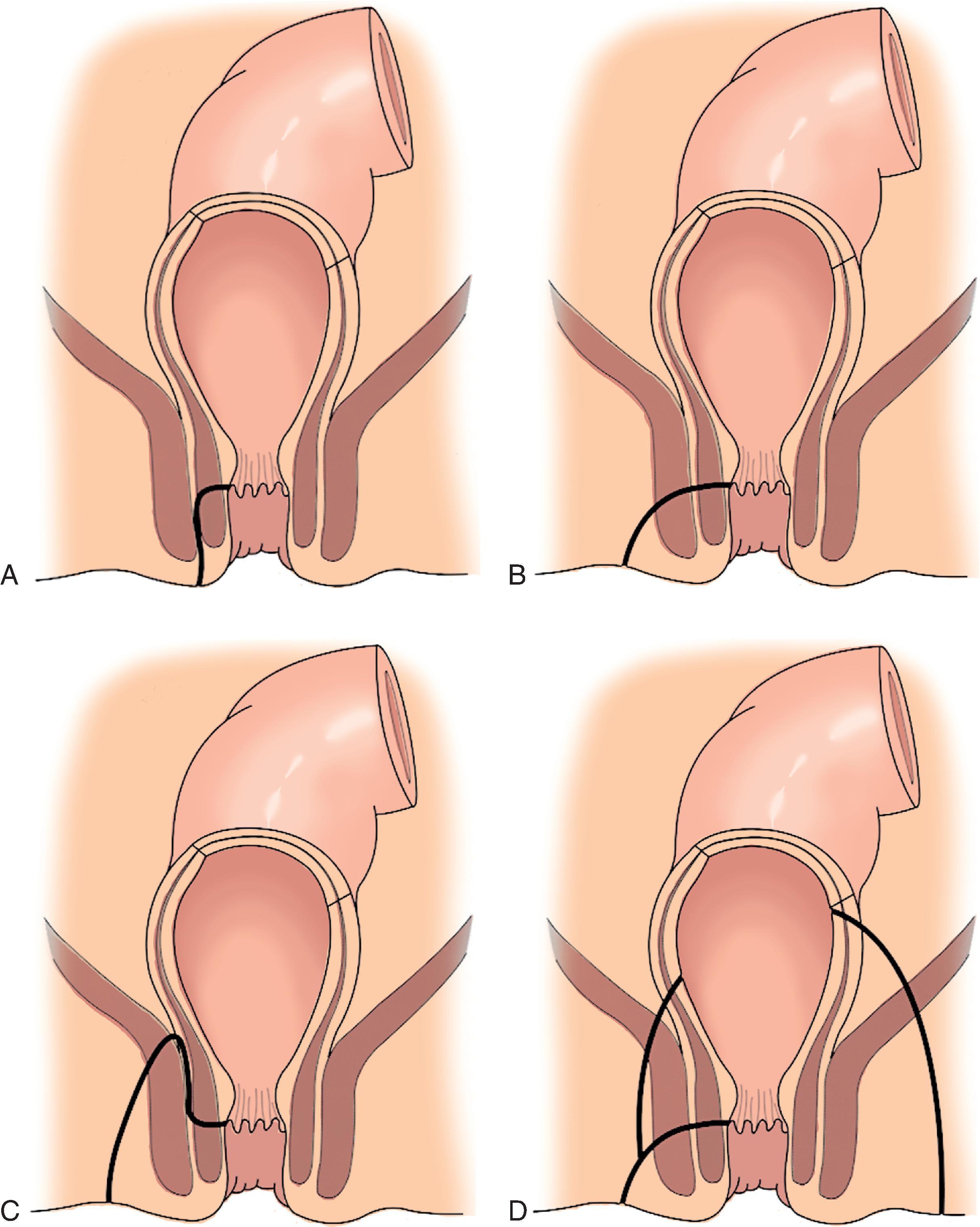 FIG. 4, Classification of anal fistulas. (A) Intersphincteric: the tract remains in the intersphincteric plane. (B) Transsphincteric: the fistula tract passes from the intersphincteric plane through the external sphincter muscle. 1, uncomplicated. (C) Suprasphincteric: there is an upward extension of the fistula tract in the intersphincteric plane. The tract then passes above the level of the puborectalis muscle and continues downward through the ischiorectal fossa to the perianal area. (D) Extrasphincteric: there is a tract that passes from the skin of the perineum through the ischiorectal fossa and the levator muscles before entering the rectal wall. This fistula may be a consequence of an extension of a transsphincteric fistula or secondary to trauma, anorectal disease, or pelvic inflammation.