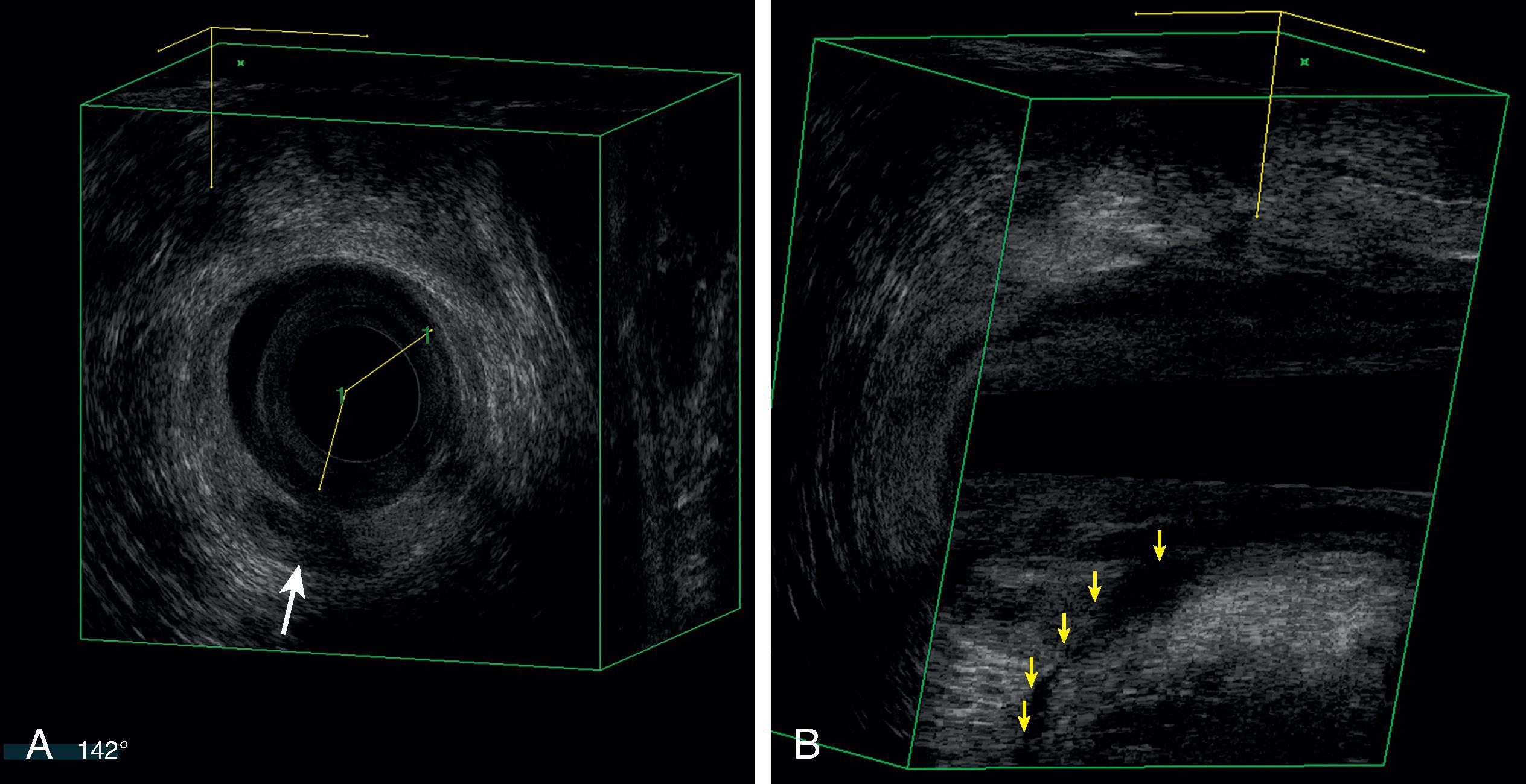 FIG. 5, Ultrasound scan of right posterior transsphincteric fistula. (A) Coronal view revealing a 142-degree internal sphincter defect on the left side from a previous hemorrhoidectomy. The hypoechoic internal opening of a right transsphincteric fistula is noted by the arrow . Given the edge of the internal sphincter defect abuts the fistula tract, ligation of the intersphincteric fistula tract procedure may not be feasible. (B) Angled sagittal view showing the hypoechoic transsphincteric fistula. Note the internal opening (arrows) nears half the length of the hyperechoic external sphincter; therefore, a fistulotomy would not be appropriate.