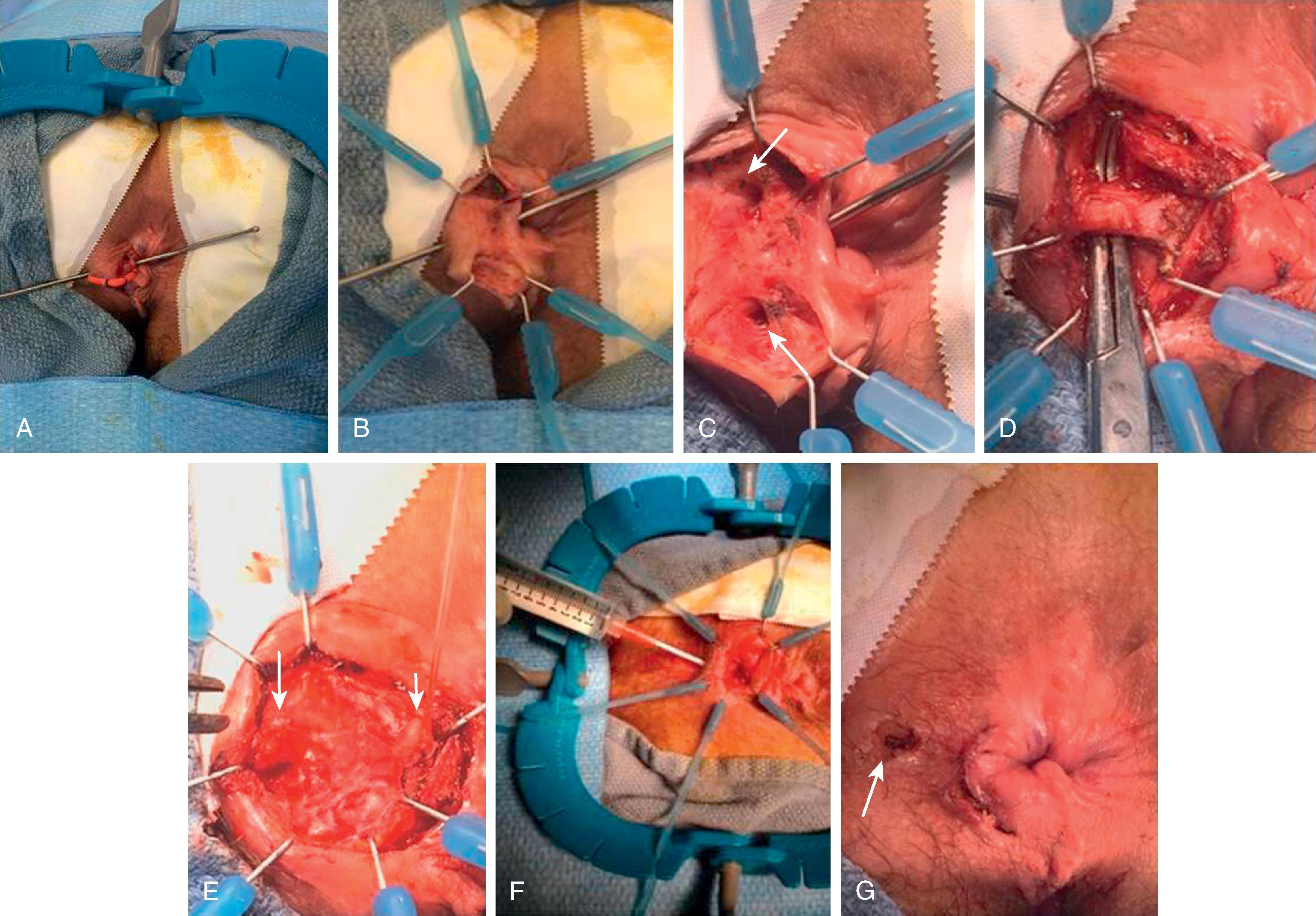 FIG. 6, (A) The fistula tract is cannulated. (B) A curvilinear incision is made overlying or slightly distal to the intersphincteric groove. A Lone Star retractor (Cooper Surgical) is helpful for exposure. (C) The intersphincteric plane is developed on either side of the tract (arrows). (D) Dissection continues around the tract until it is isolated. The probe is removed. (E) Division and ligation of the fistula tract. The tract is encircled with a Vicryl (Ethicon) tie, and the tract is ligated at the border of the internal anal sphincter (right arrow). If a long tract is present, it can be excised, and the tract near the external anal sphincter is either ligated or imbricated with Vicryl suture (left arrow) . (F) The repair is tested by injecting hydrogen peroxide into the internal and external openings. The ligated ends can also be probed to ensure closure. If there is a leak, the fistula opening is further imbricated. (G) The external opening (arrow) is slightly enlarged, and the distal aspect of the tract is debrided with a curette.