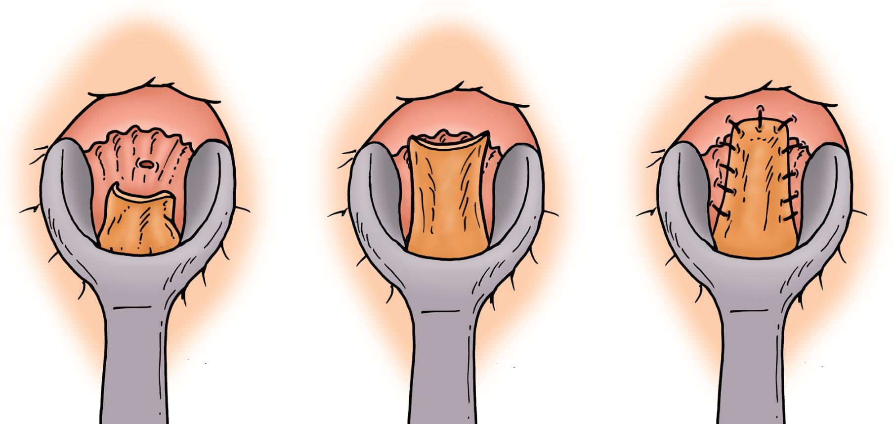 FIG. 7, Mucosal (Martin’s) advancement flap. A longitudinal incision is made over the strictured area in the anal canal. Proximal rectal and anal mucosa are then undermined through a transverse incision starting at the proximal end of a previously made longitudinal incision. The flap is then sutured to the distal edge of the internal anal sphincter, leaving open the most distal aspect of the wound.