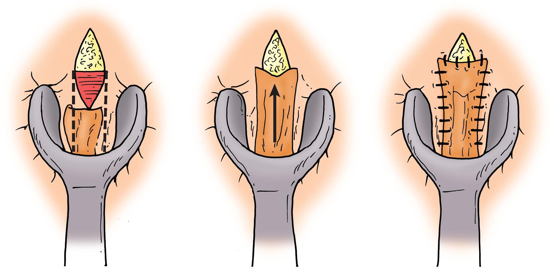 FIG. 1, Mucosal advancement flap.