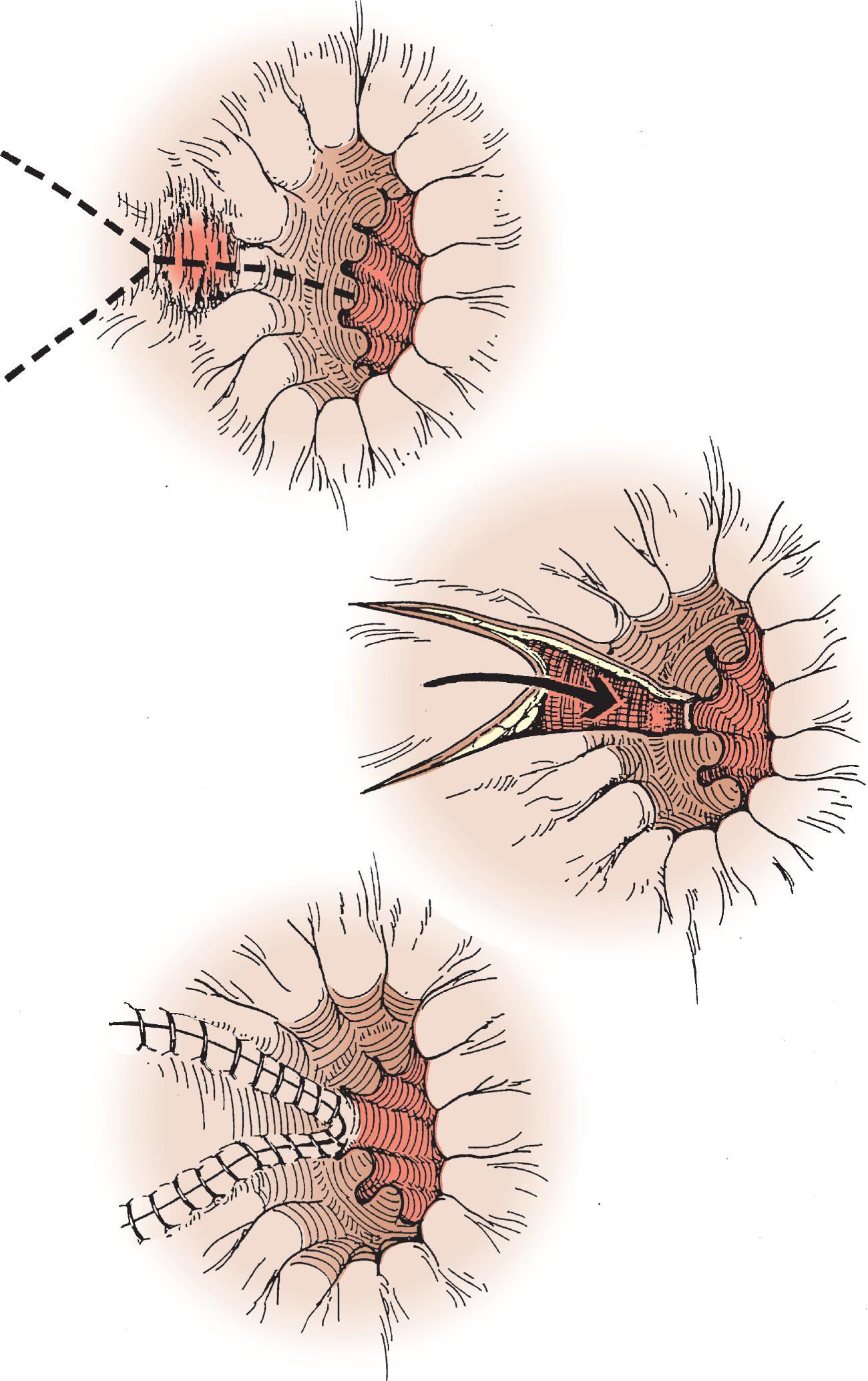 FIG. 2, Y-V advancement flap.