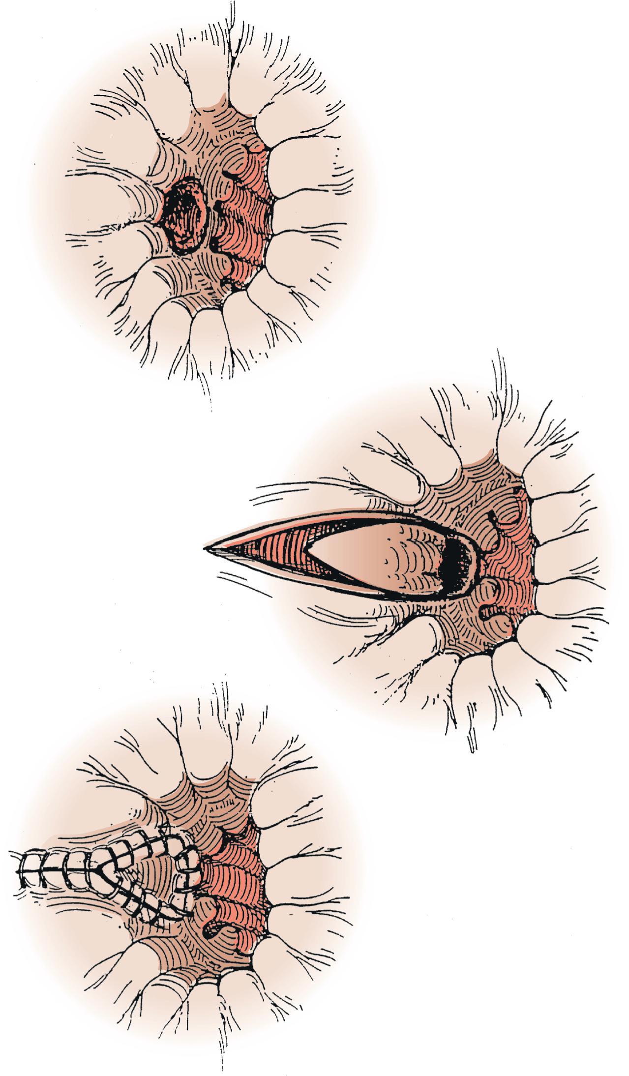 FIG. 3, V-Y flap.