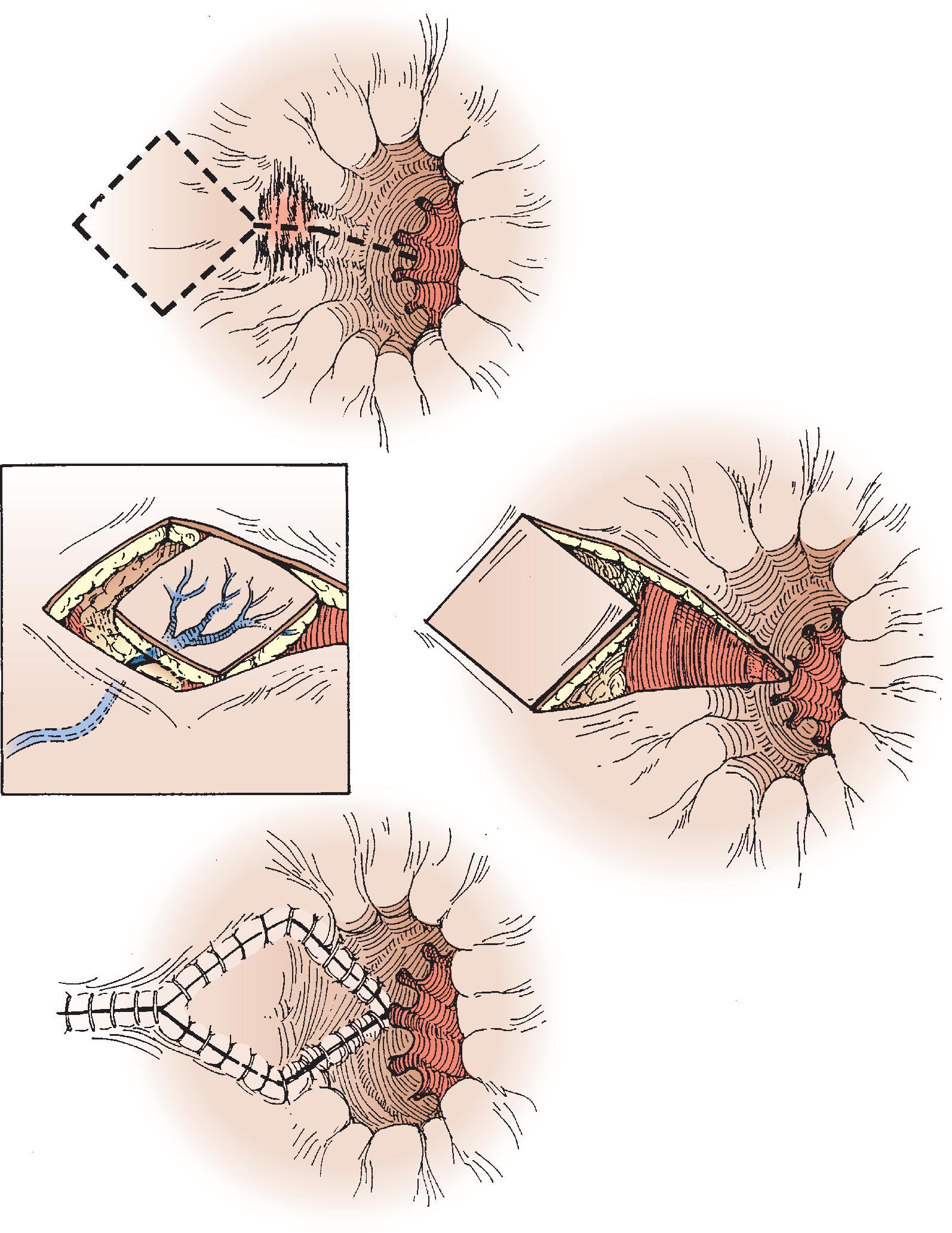 FIG. 5, Diamond flap.